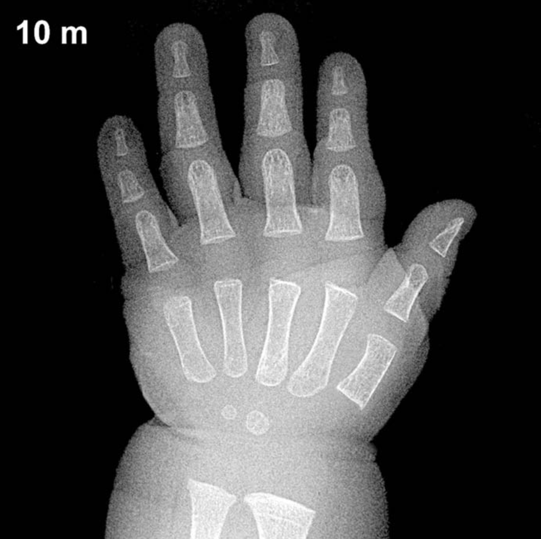 Bone age hand x-ray of a 10 month old boy