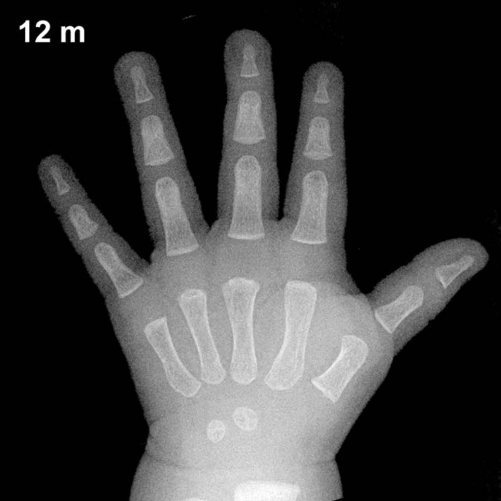Bone age hand x-ray of a 12 month old boy