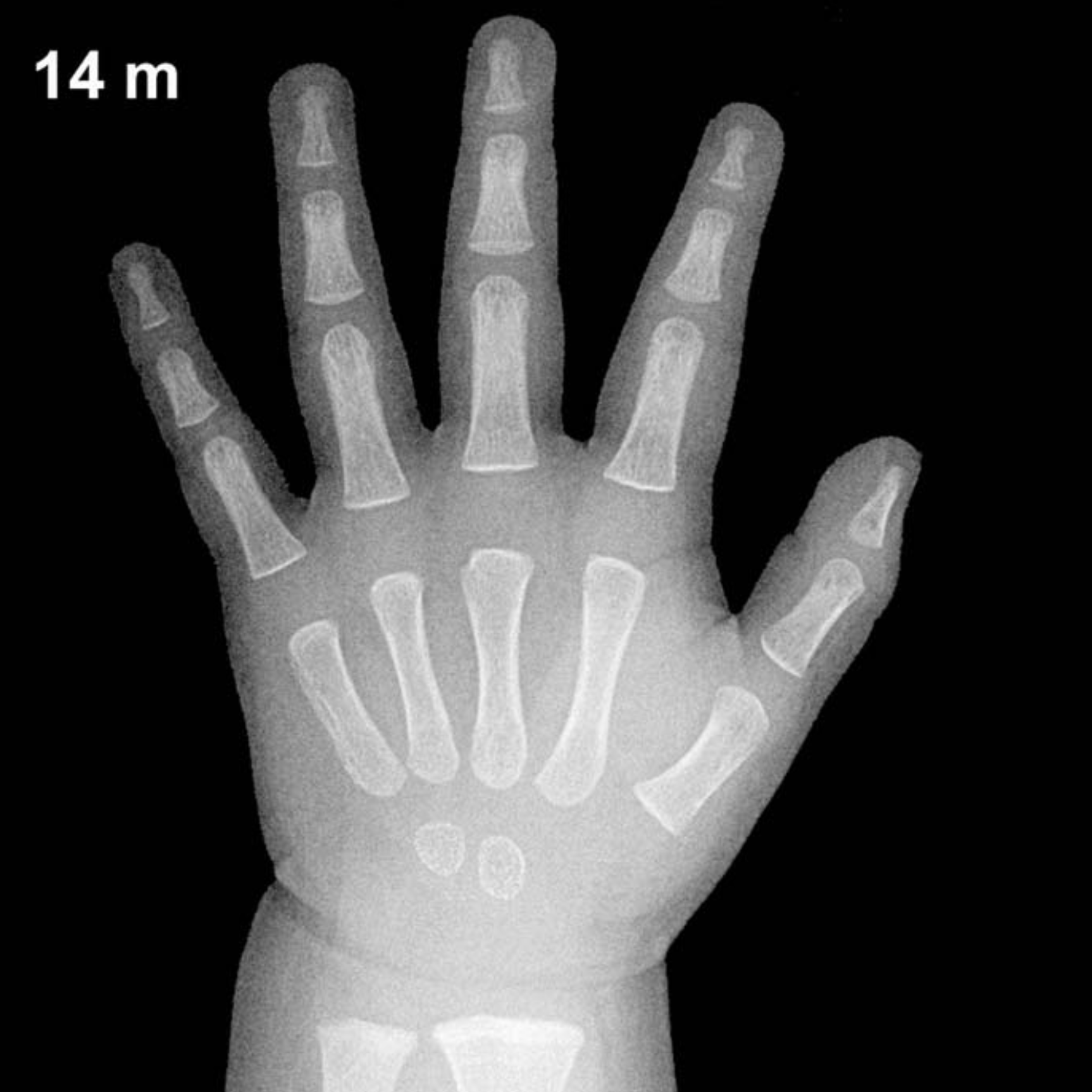 Bone age hand x-ray of a 14 month old boy