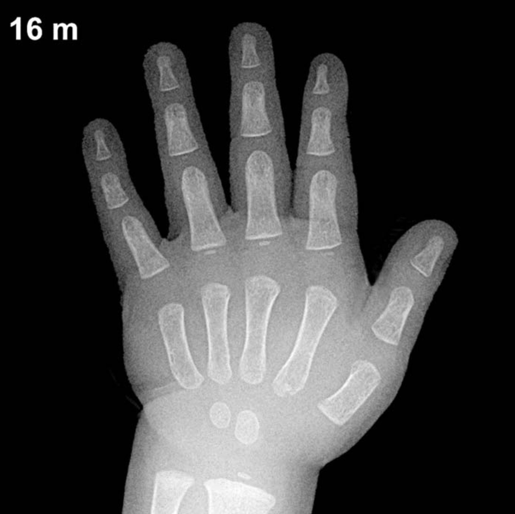 Bone age hand x-ray of a 16 month old boy
