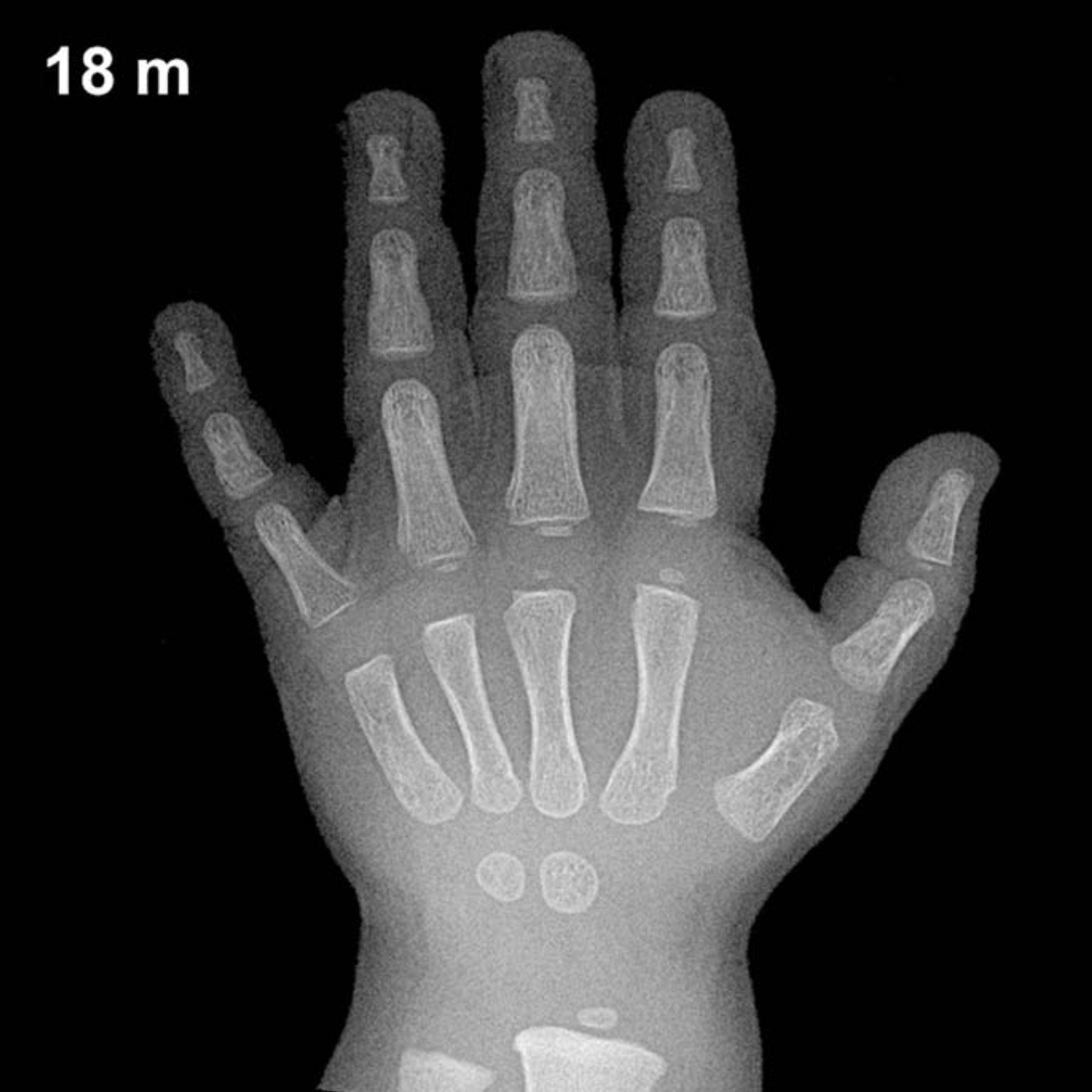 Bone age hand x-ray of a 18 month old boy