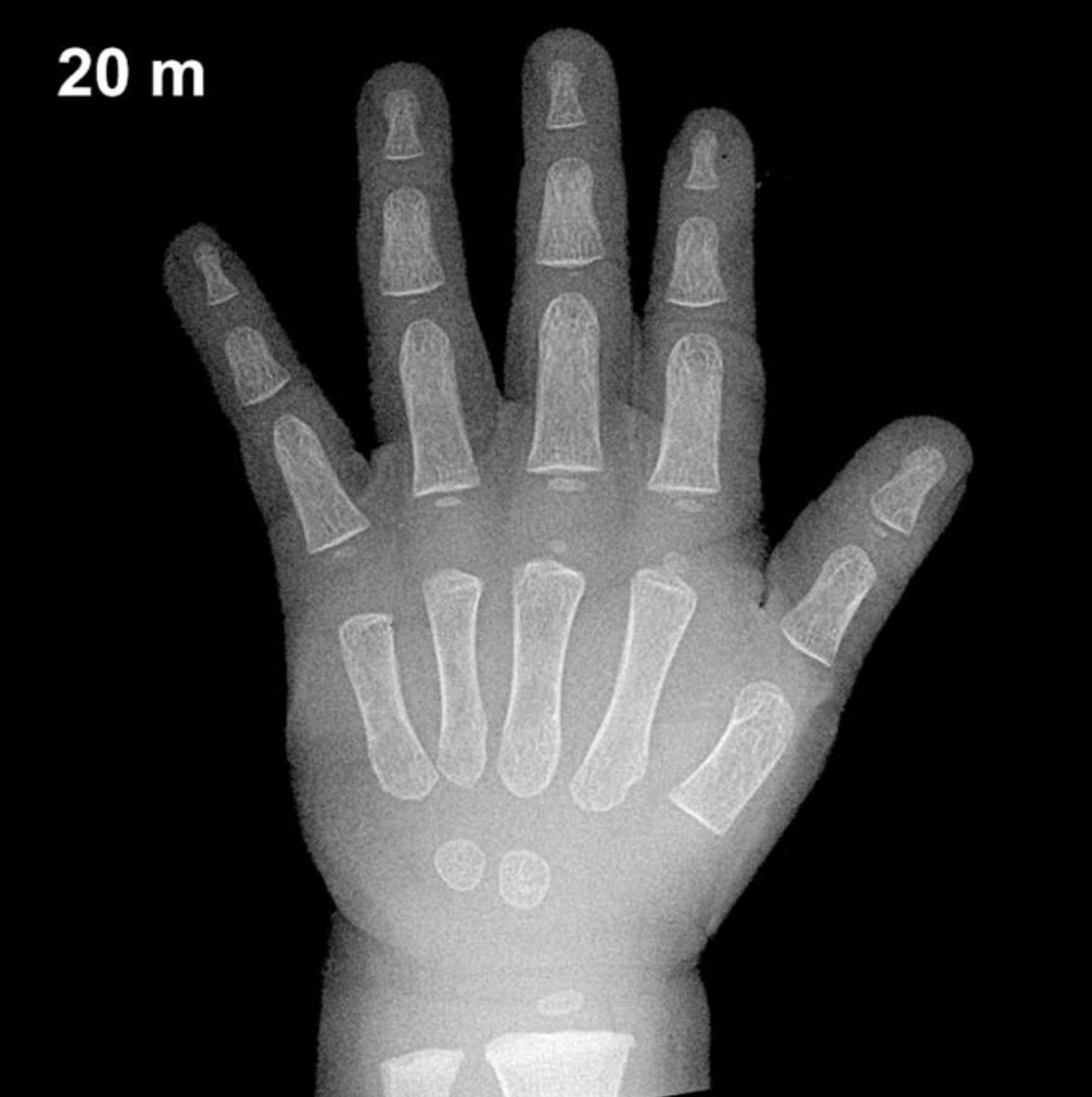 Bone age hand x-ray of a 20 month old boy
