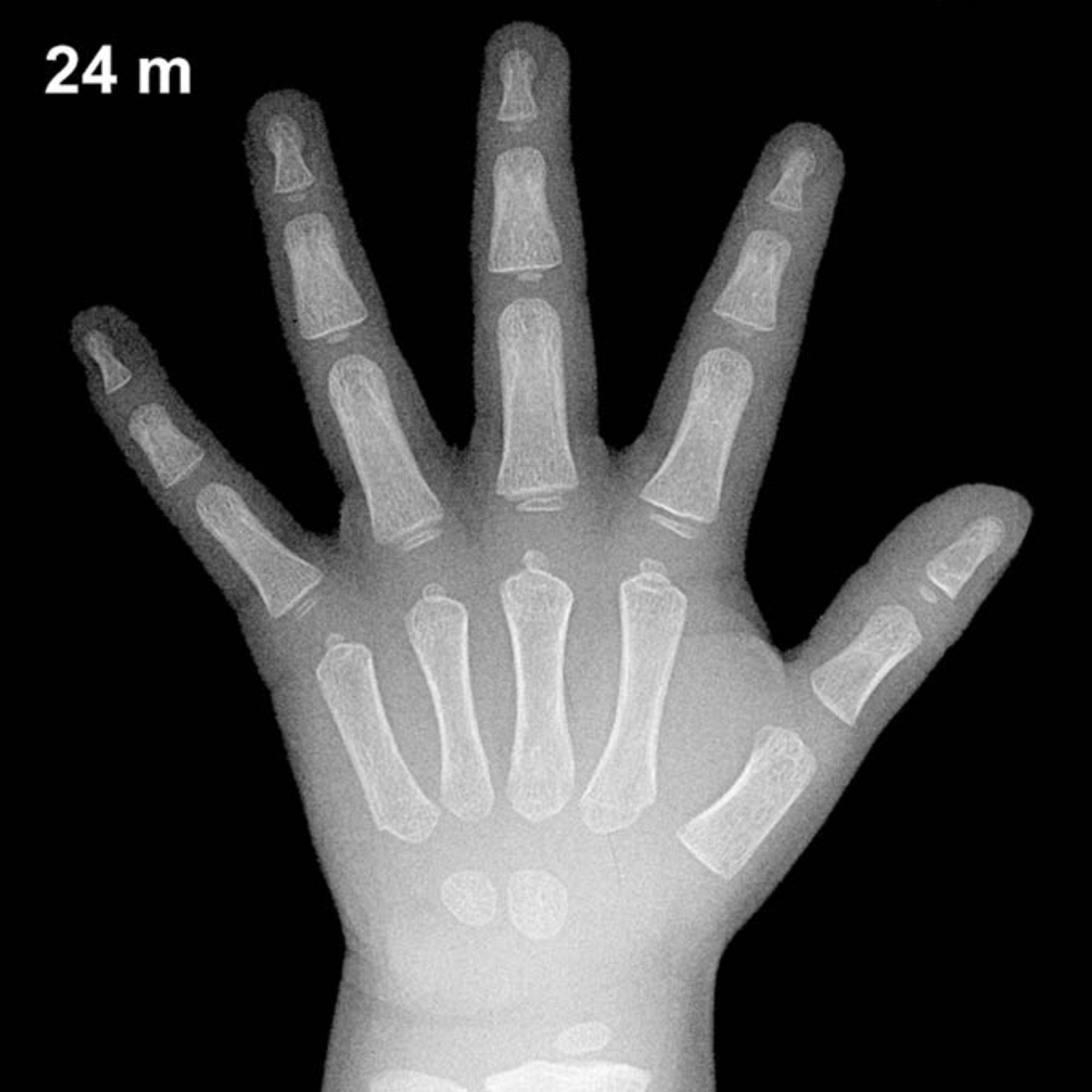 Bone age hand x-ray of a 2 year old boy