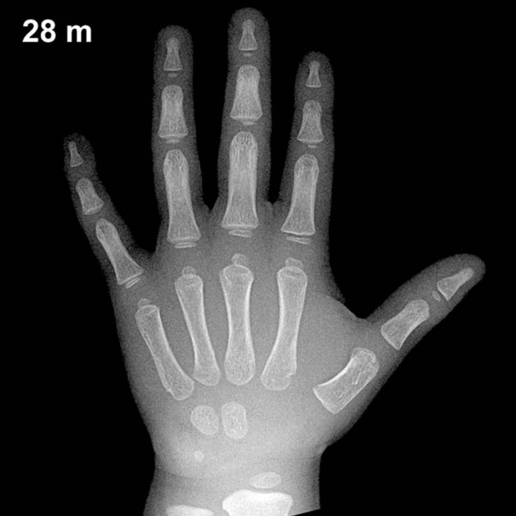 Bone age hand x-ray of a 28 month old boy