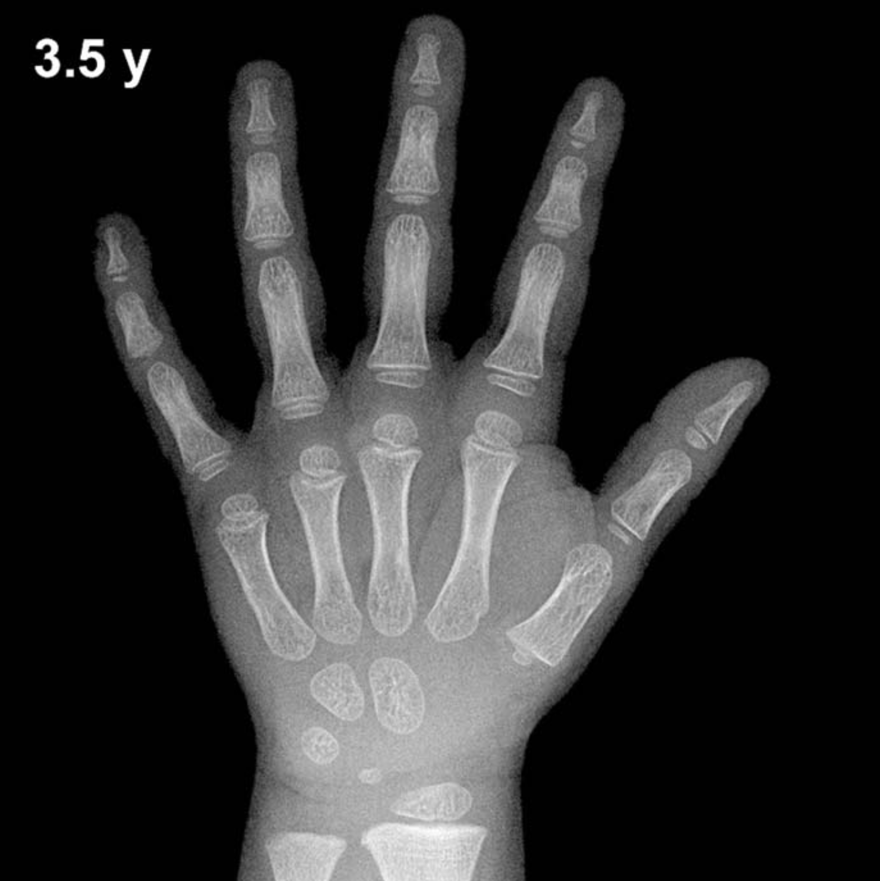 Bone age hand x-ray of a 3.5 year old boy