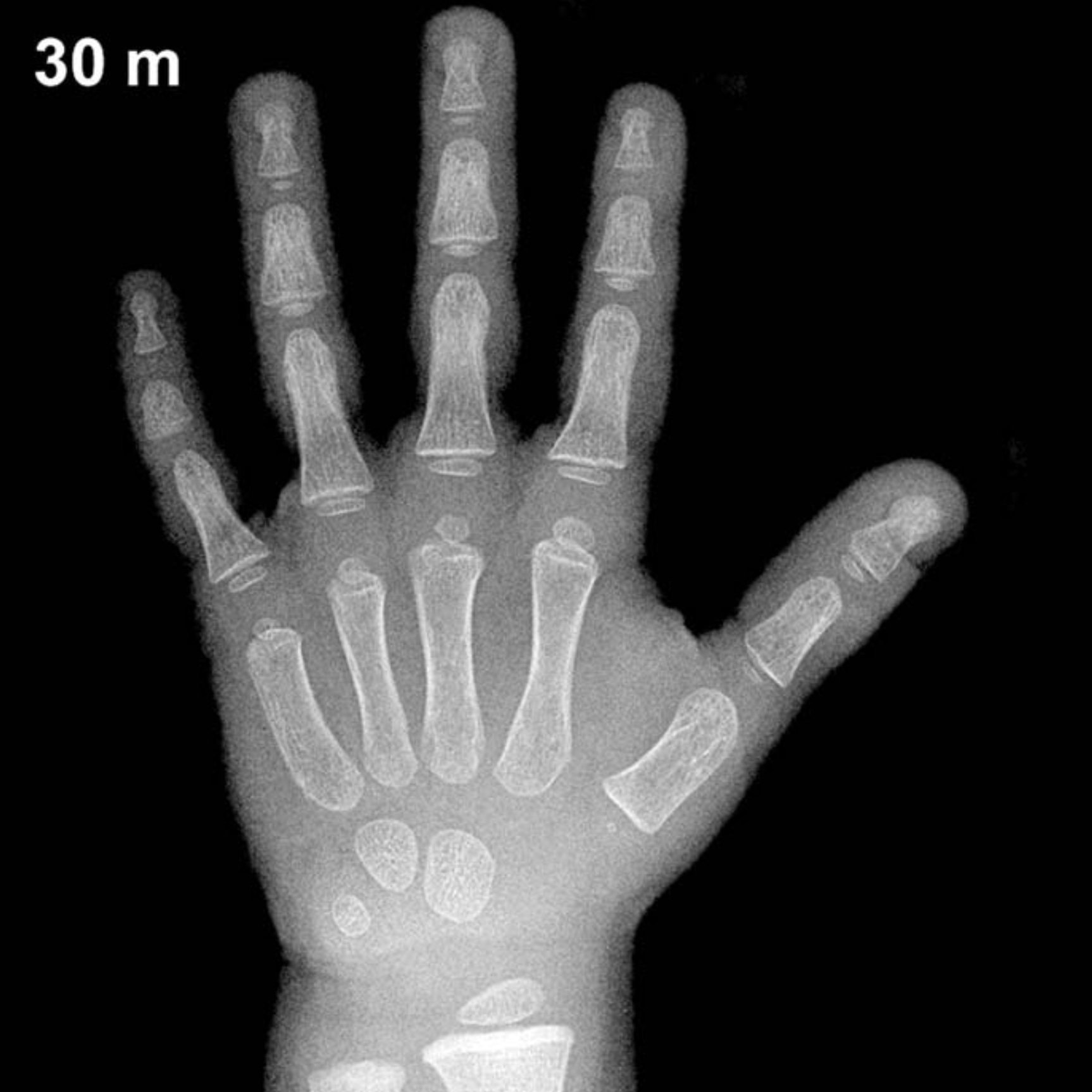 Bone age hand x-ray of a 2.5 year old boy