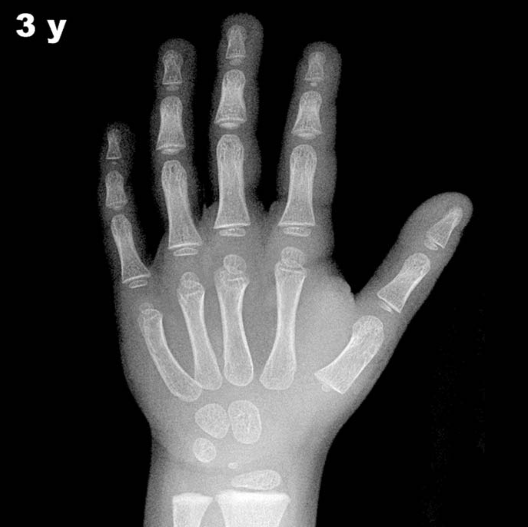 Bone age hand x-ray of a 3 year old boy