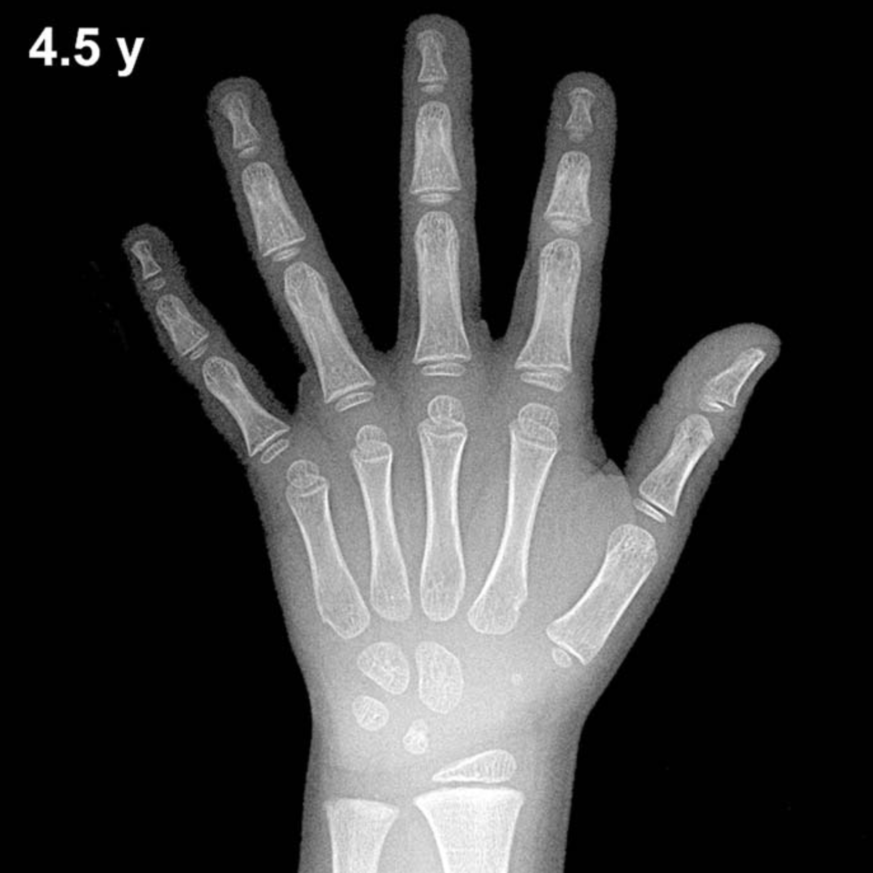 Bone age hand x-ray of a 4.5 year old boy