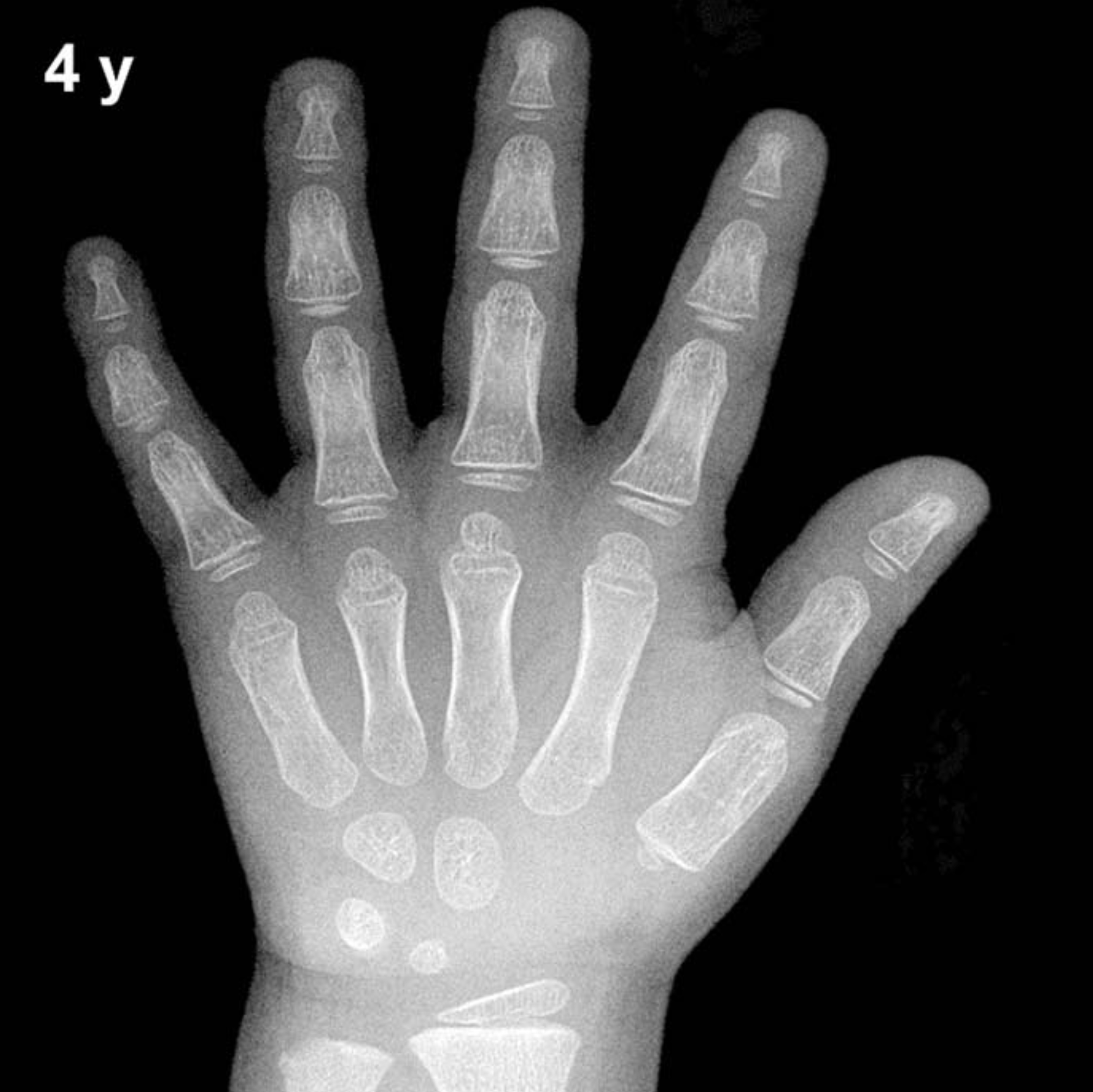 Bone age hand x-ray of a 4 year old boy