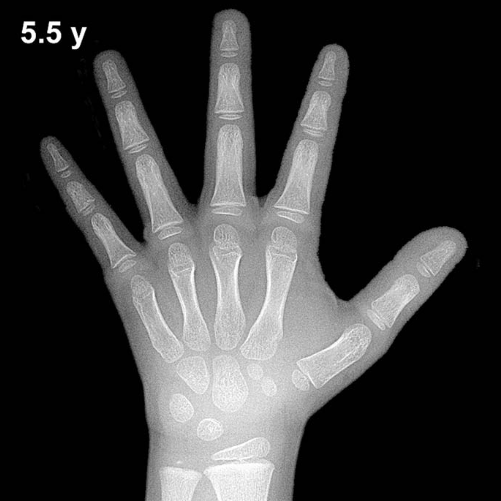 Bone age hand x-ray of a 5.5 year old boy