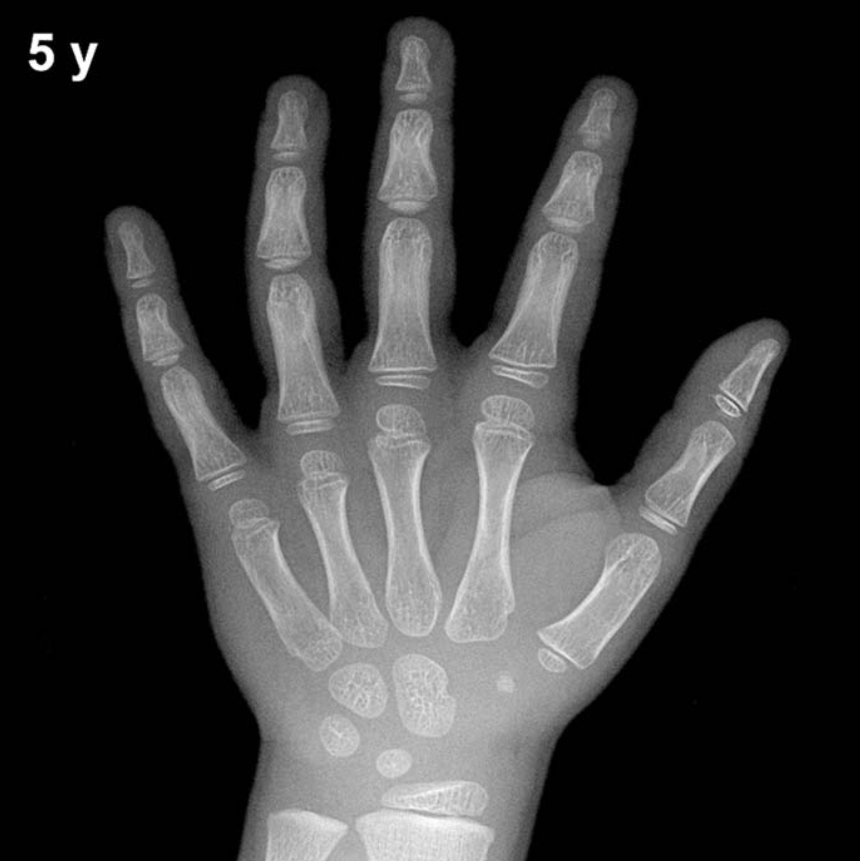 Bone age hand x-ray of a 5 year old boy