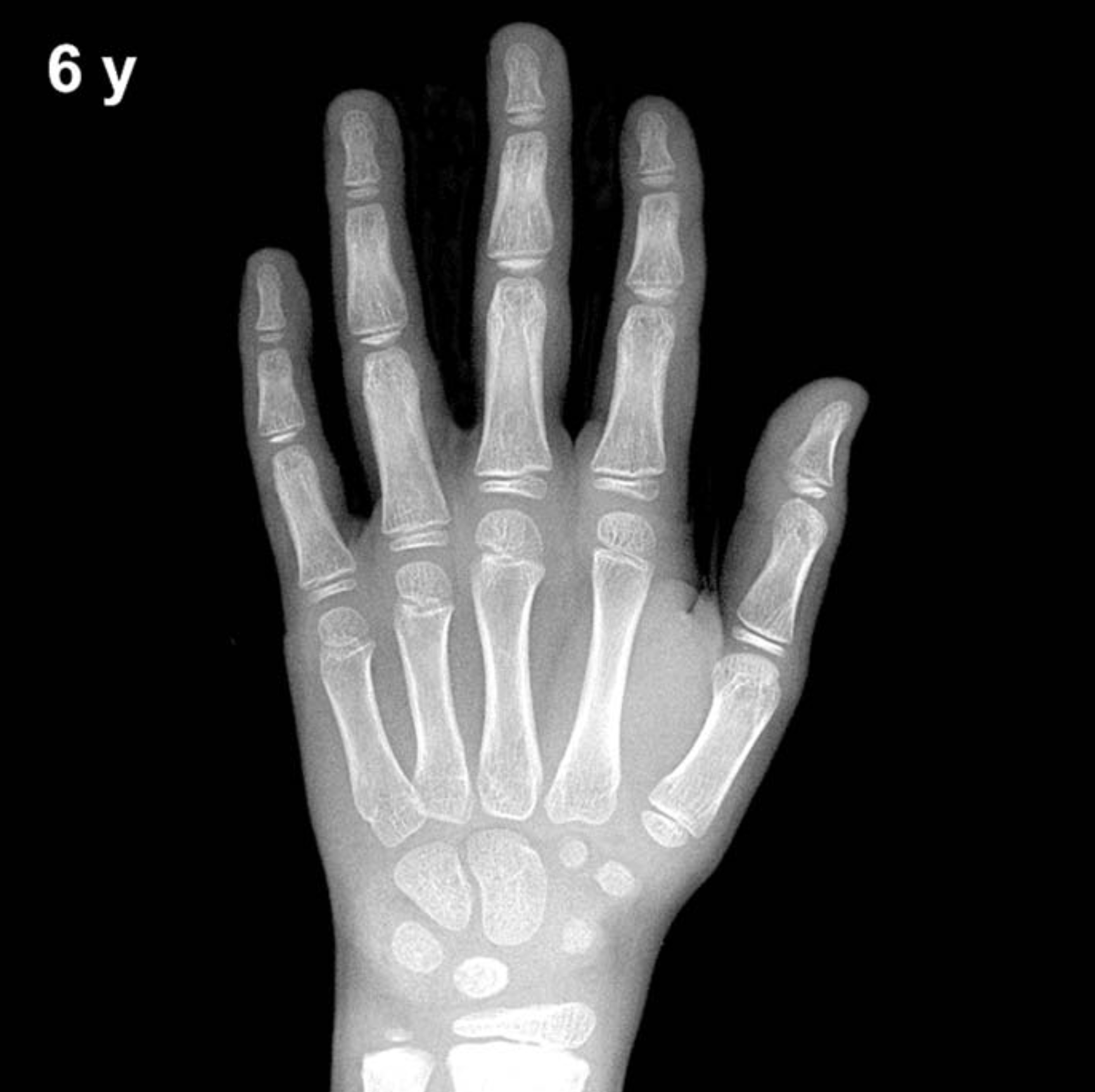 Bone age hand x-ray of a 6 year old boy