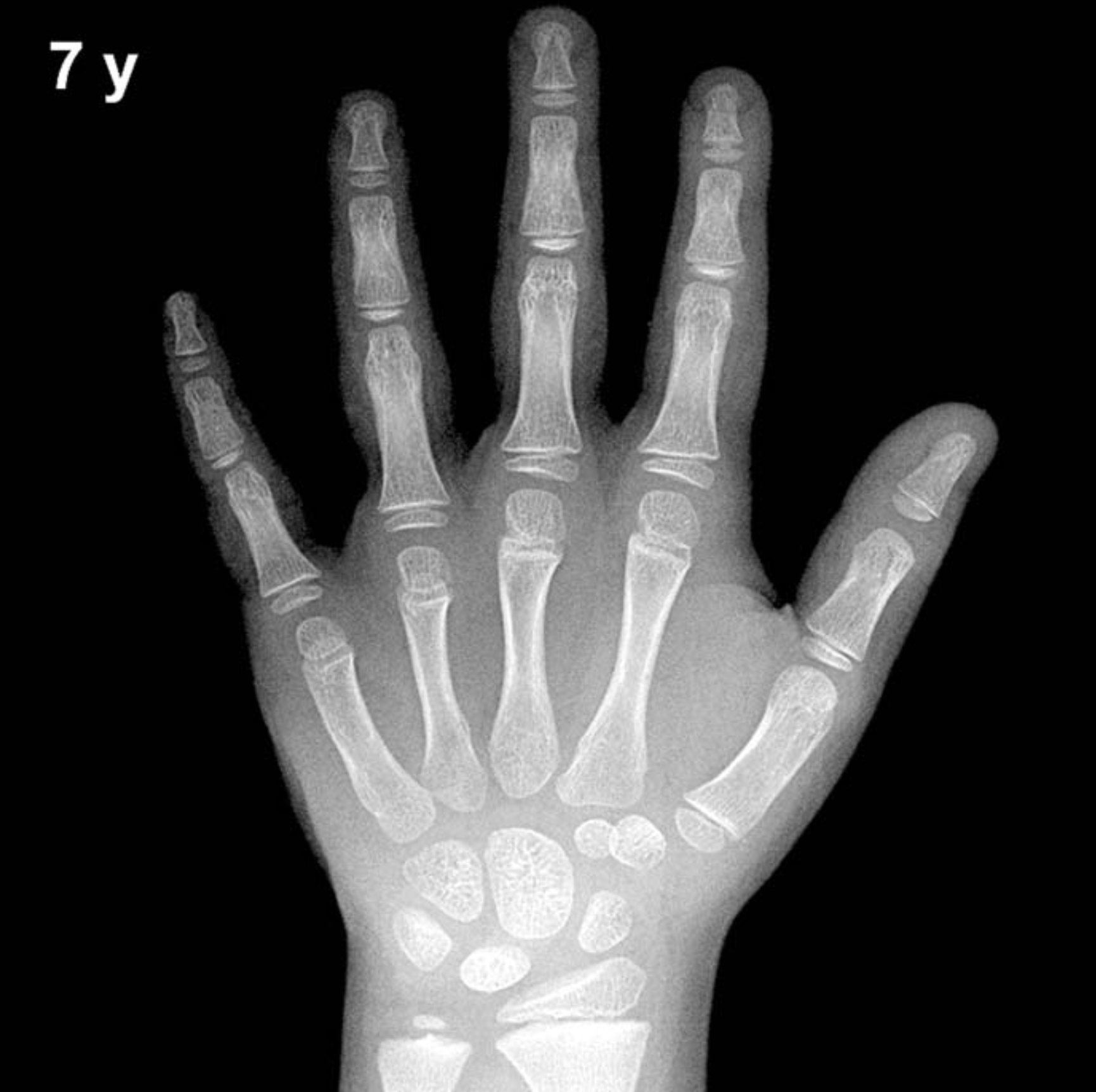 Bone age hand x-ray of a 7 year old boy