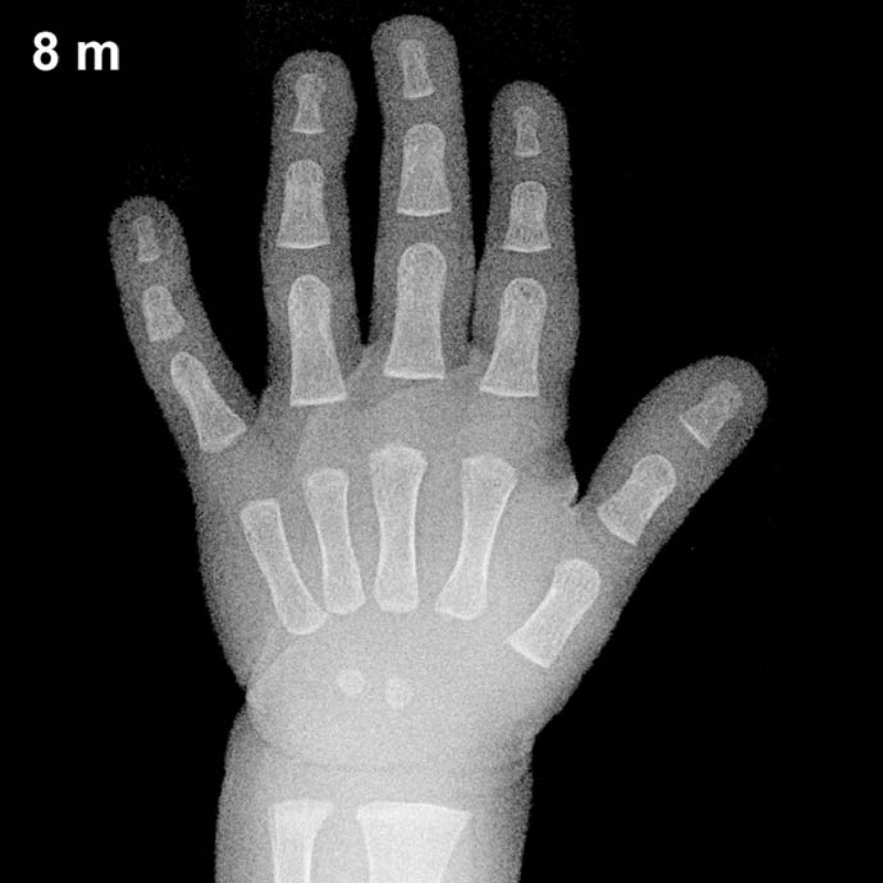 Bone age hand x-ray of a 8 month old boy
