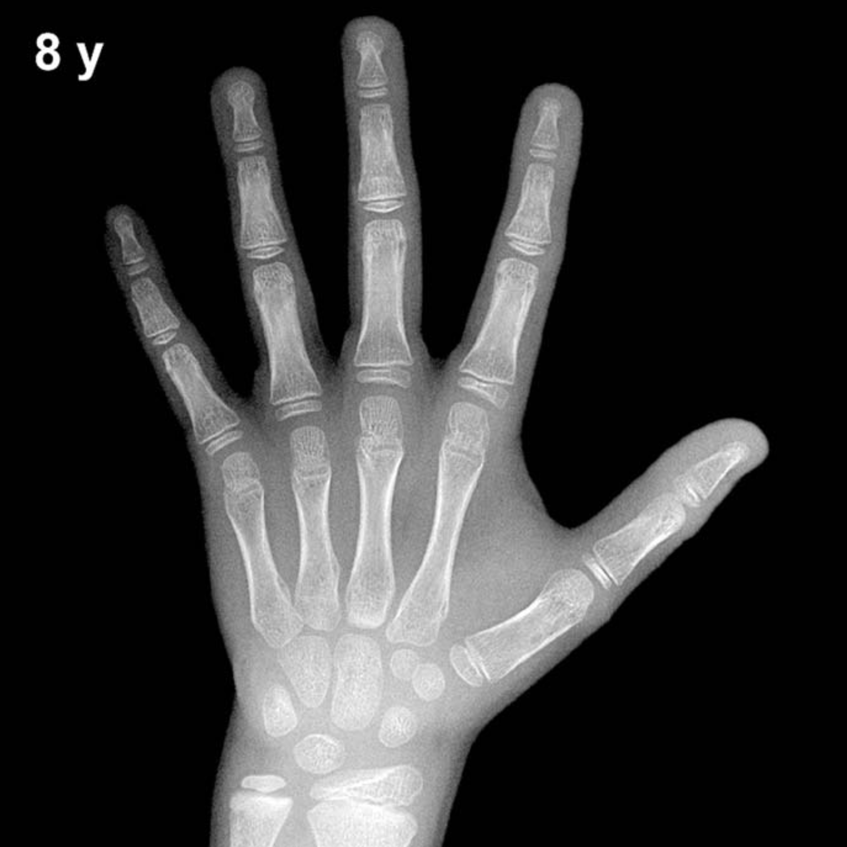 Bone age hand x-ray of a 8 year old boy