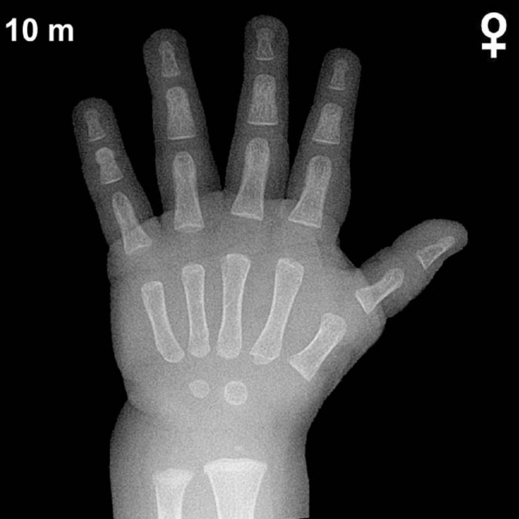 Bone age hand x-ray of a 10 month old girl
