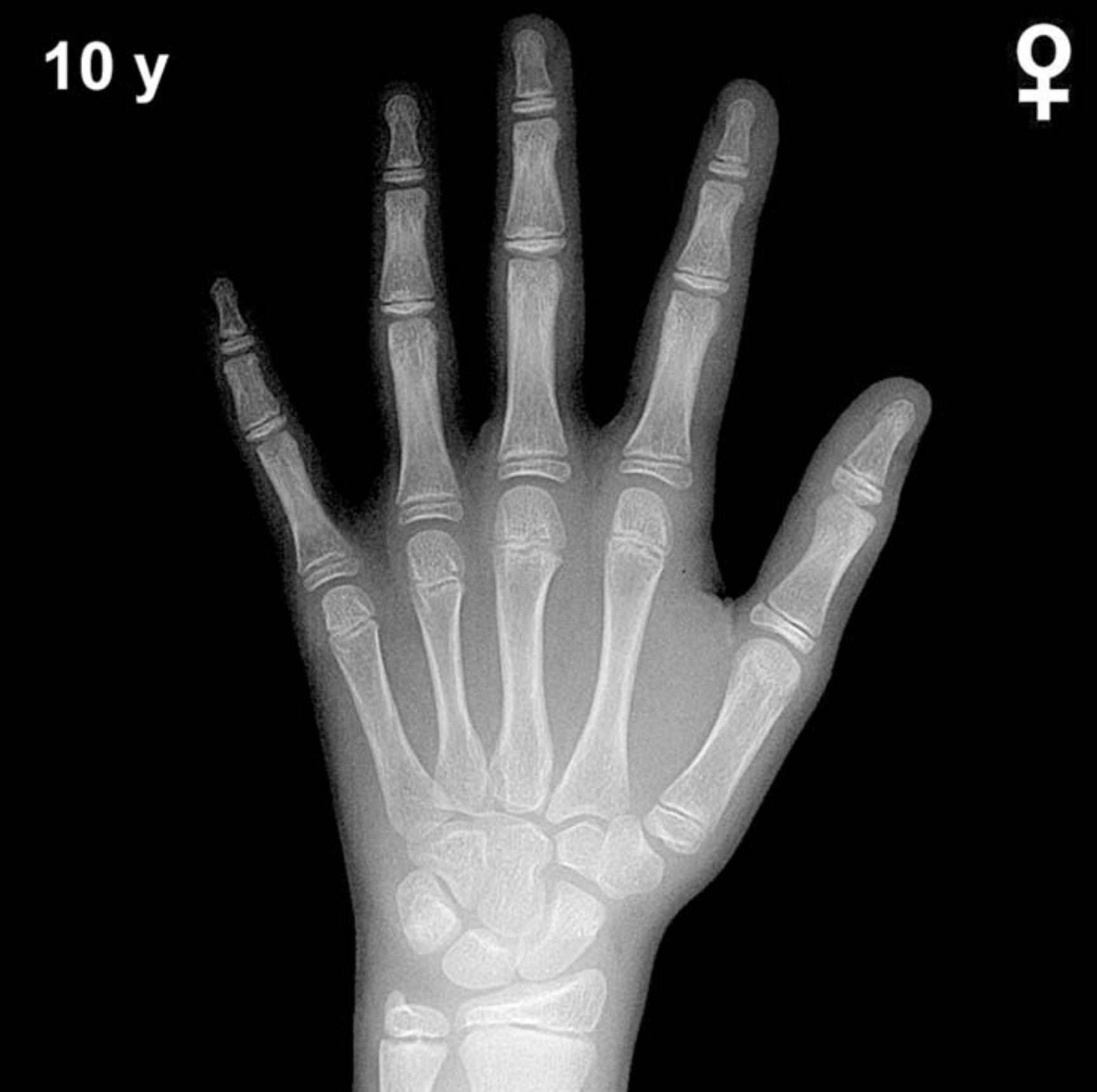 Bone age hand x-ray of a 10 year old girl