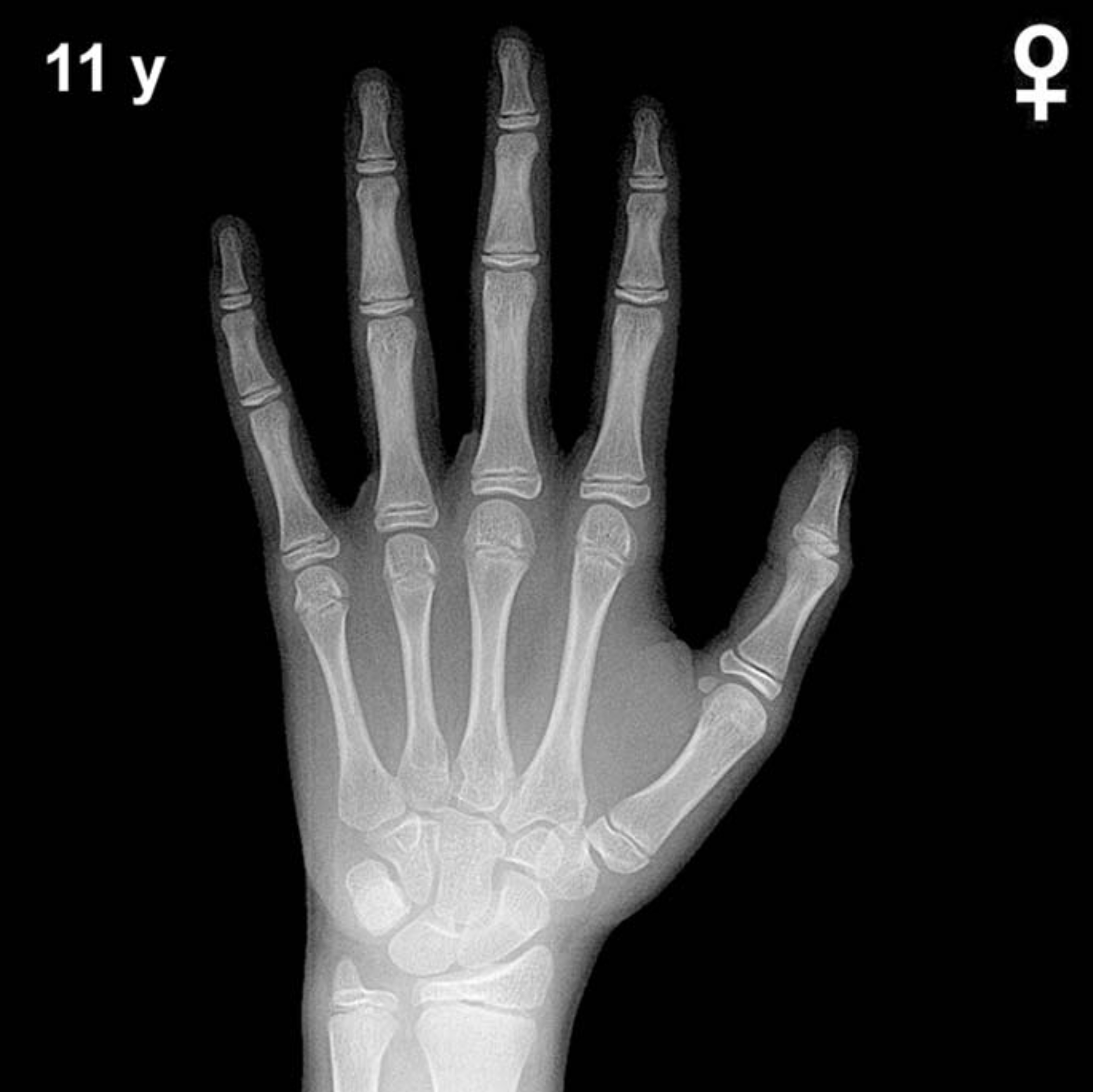 Bone age hand x-ray of a 11 year old girl