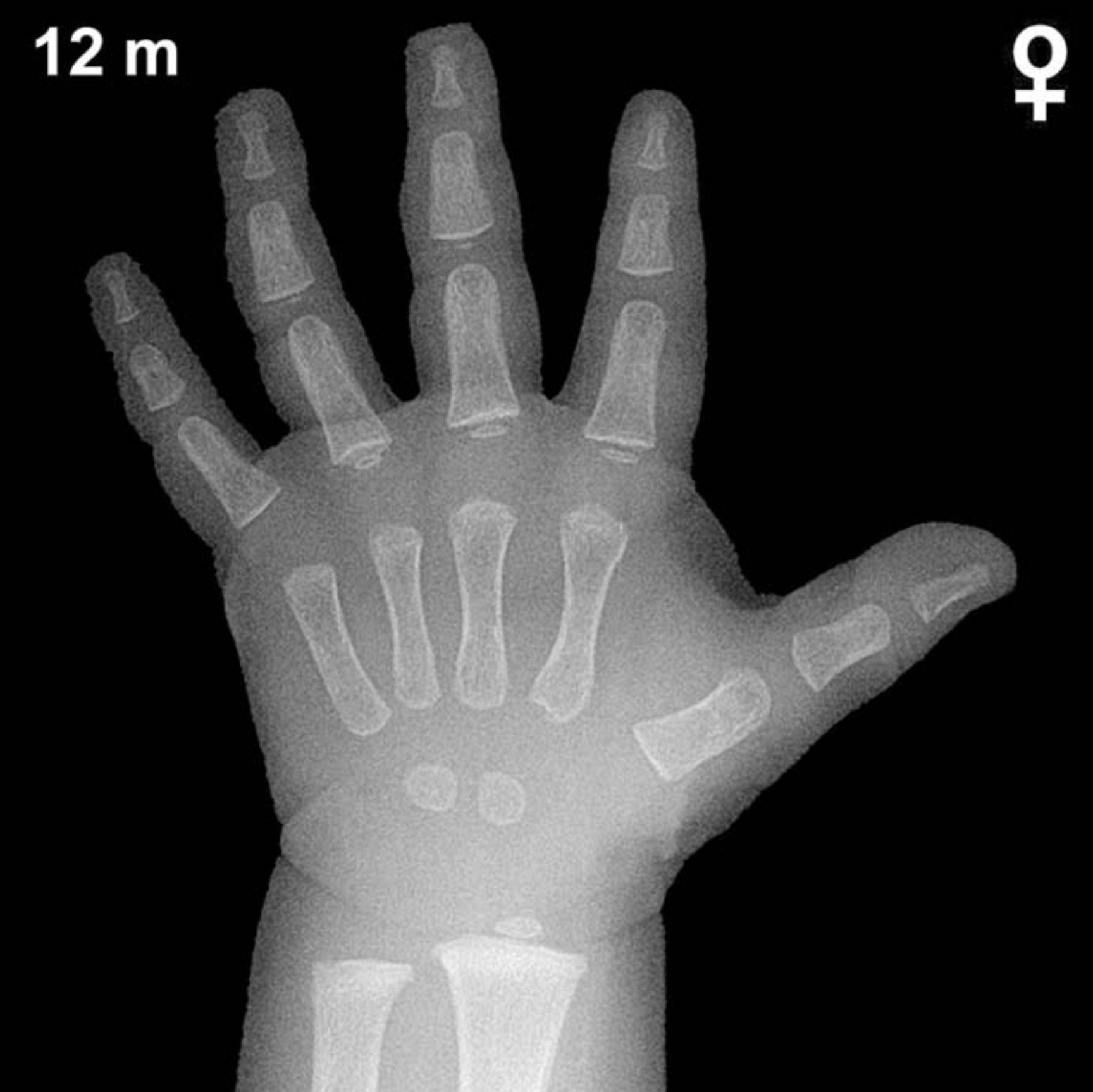 Bone age hand x-ray of a 12 month old girl