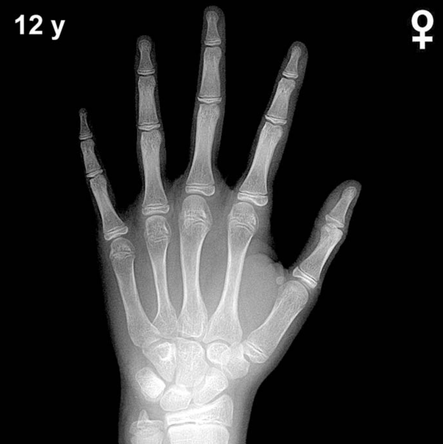 Bone age hand x-ray of a 12 year old girl