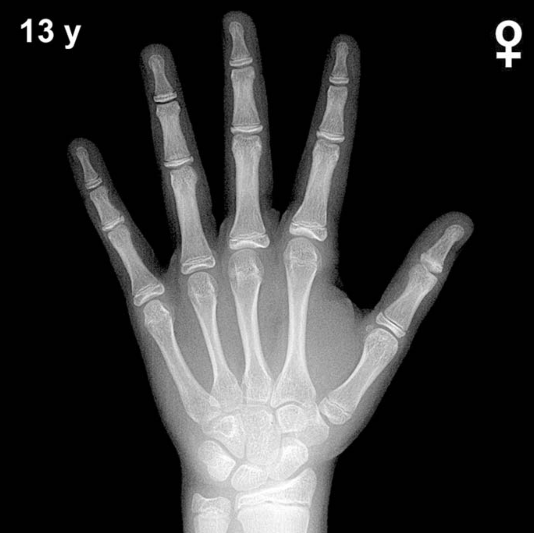 Bone age hand x-ray of a 13 year old girl