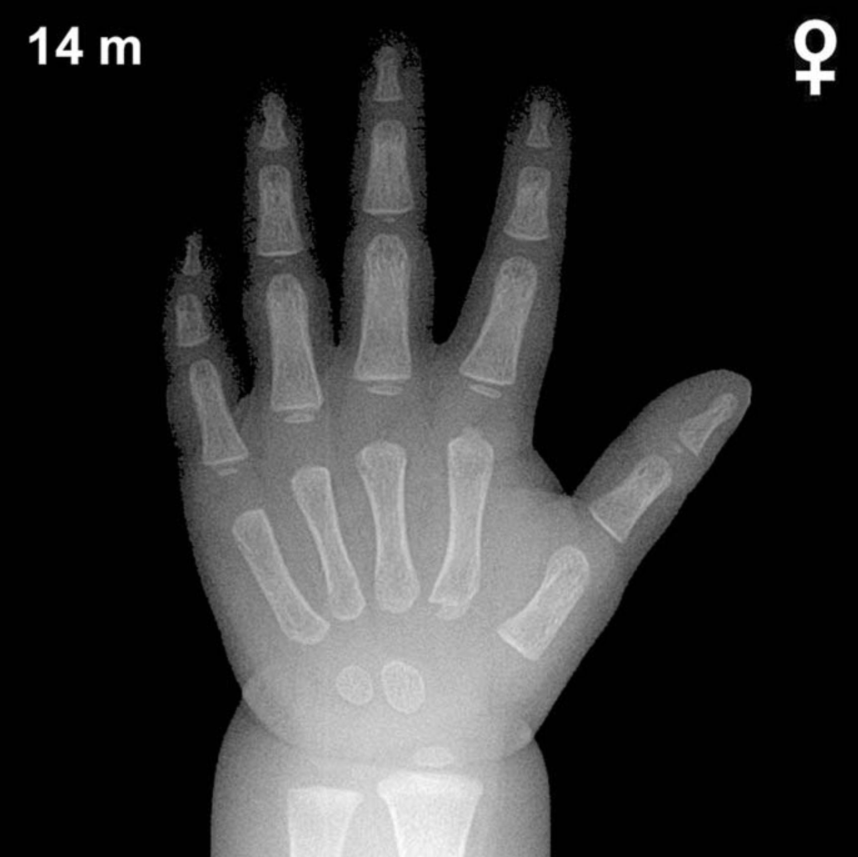 Bone age hand x-ray of a 14 month old girl