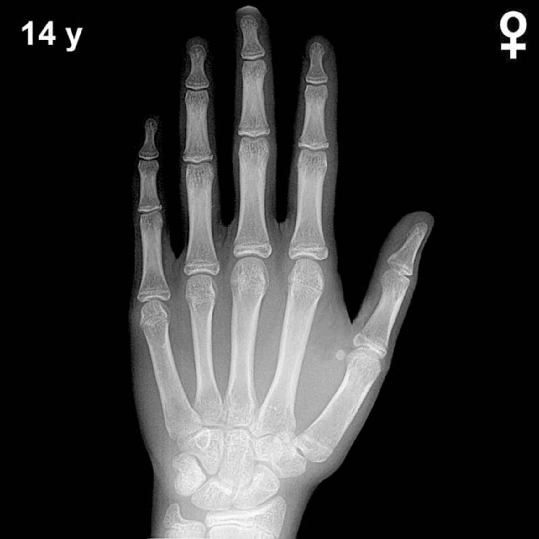 Bone age hand x-ray of a 14 year old girl