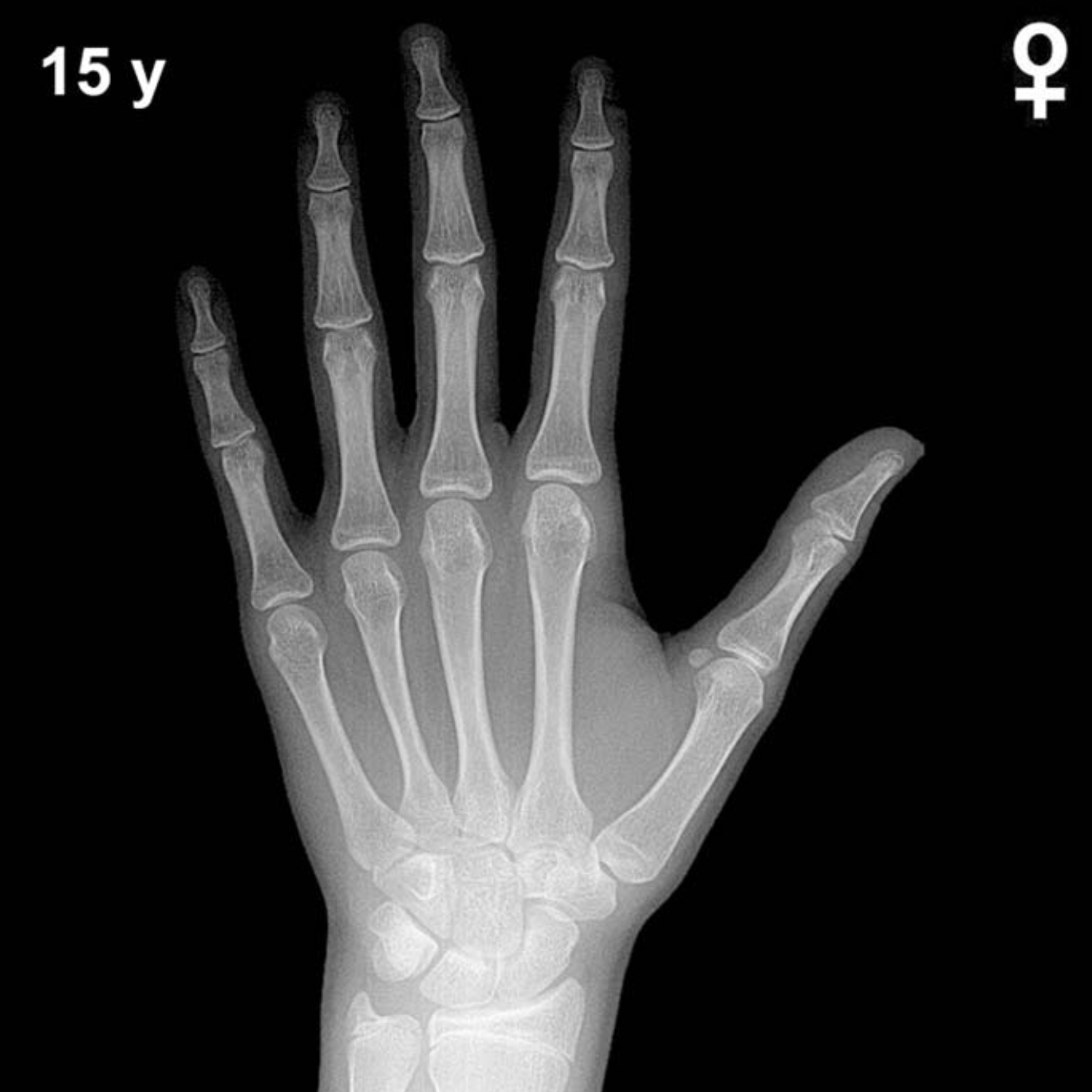 Bone age hand x-ray of a 15 year old girl