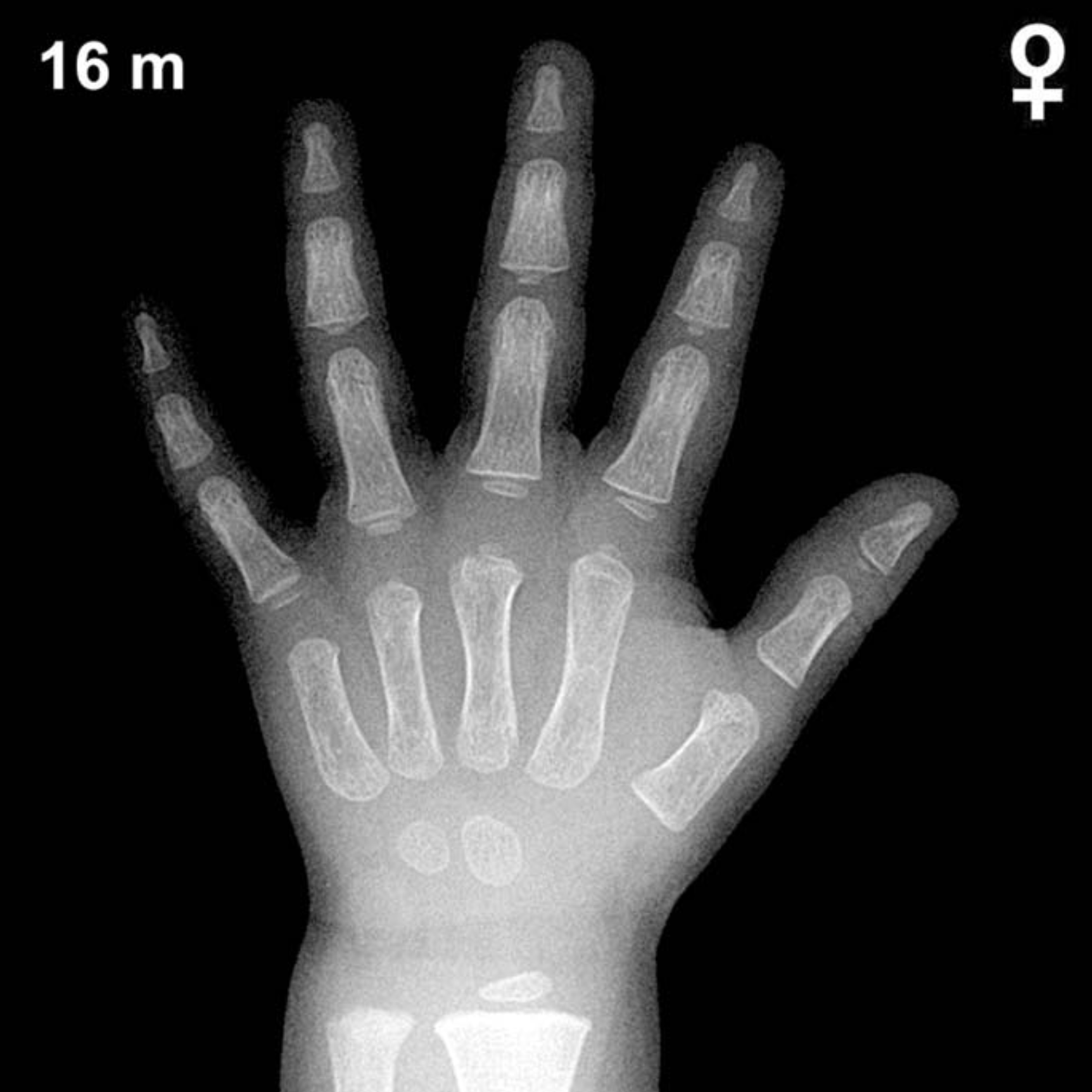 Bone age hand x-ray of a 16 month old girl