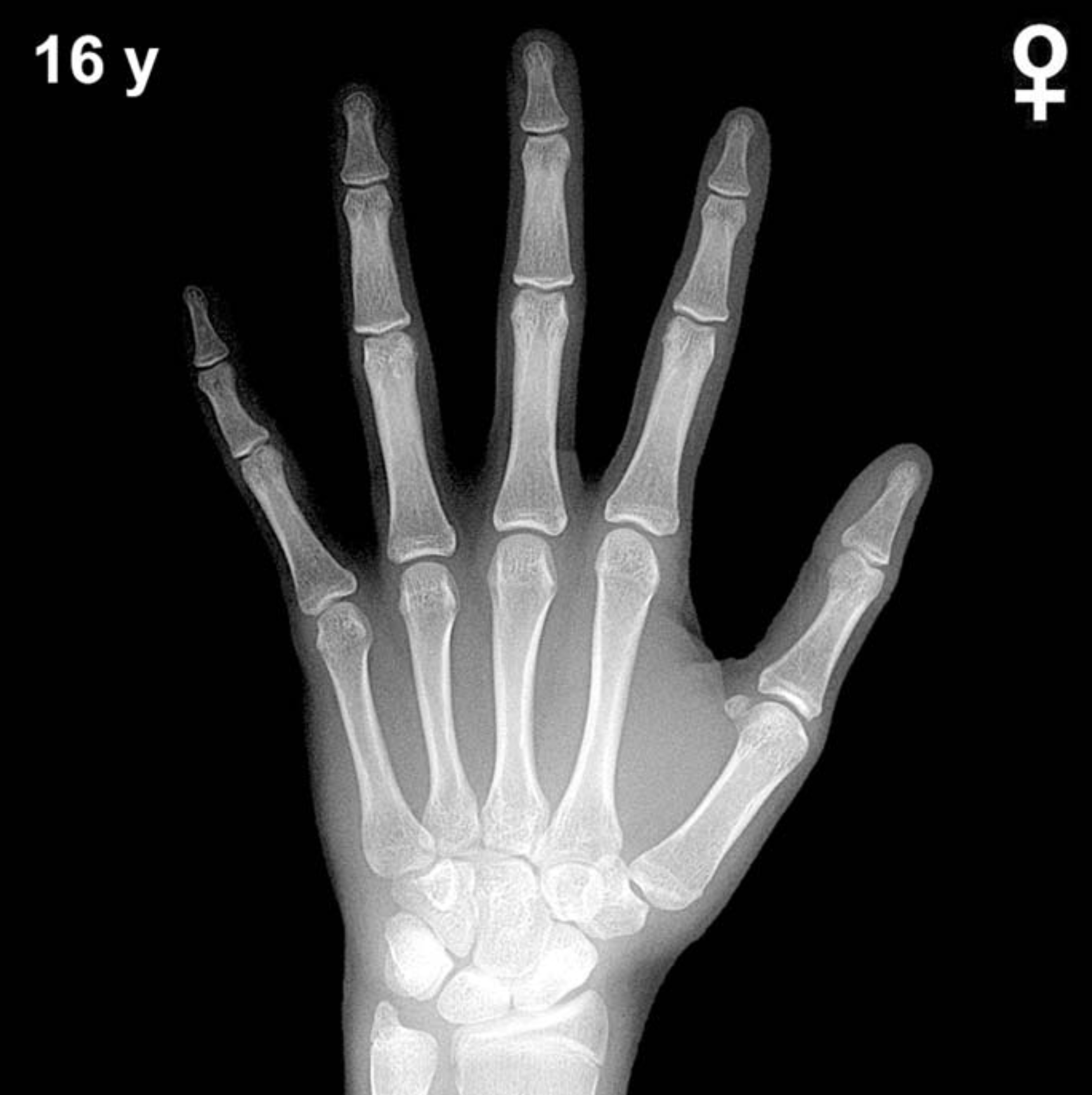 Bone age hand x-ray of a 16 year old girl