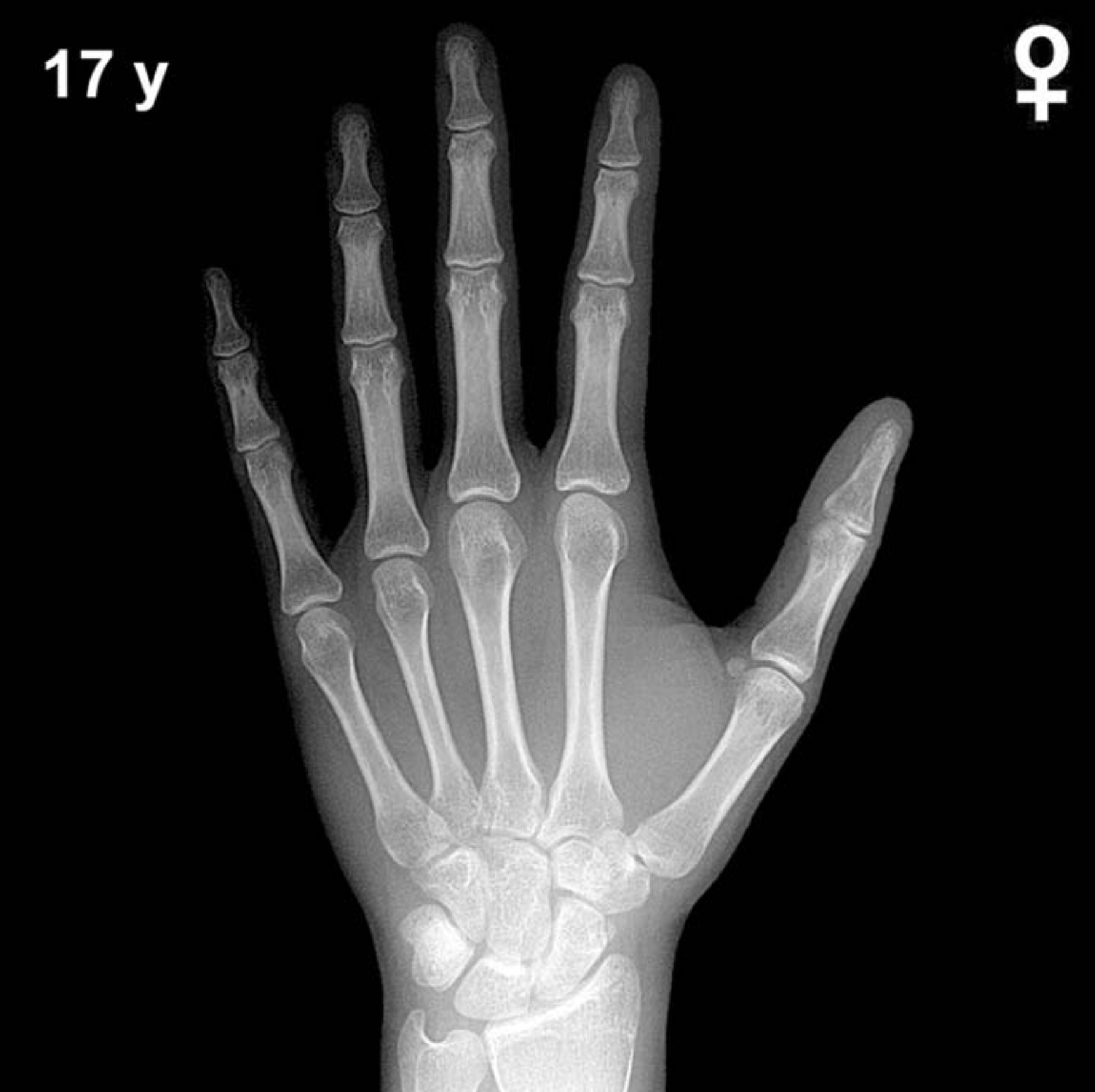 Bone age hand x-ray of a 17 year old girl