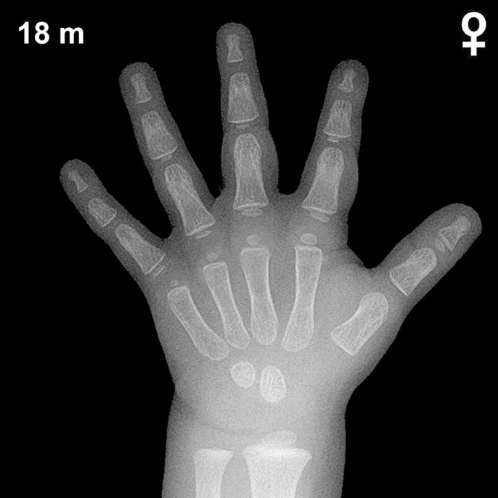 Bone age hand x-ray of a 18 month old girl