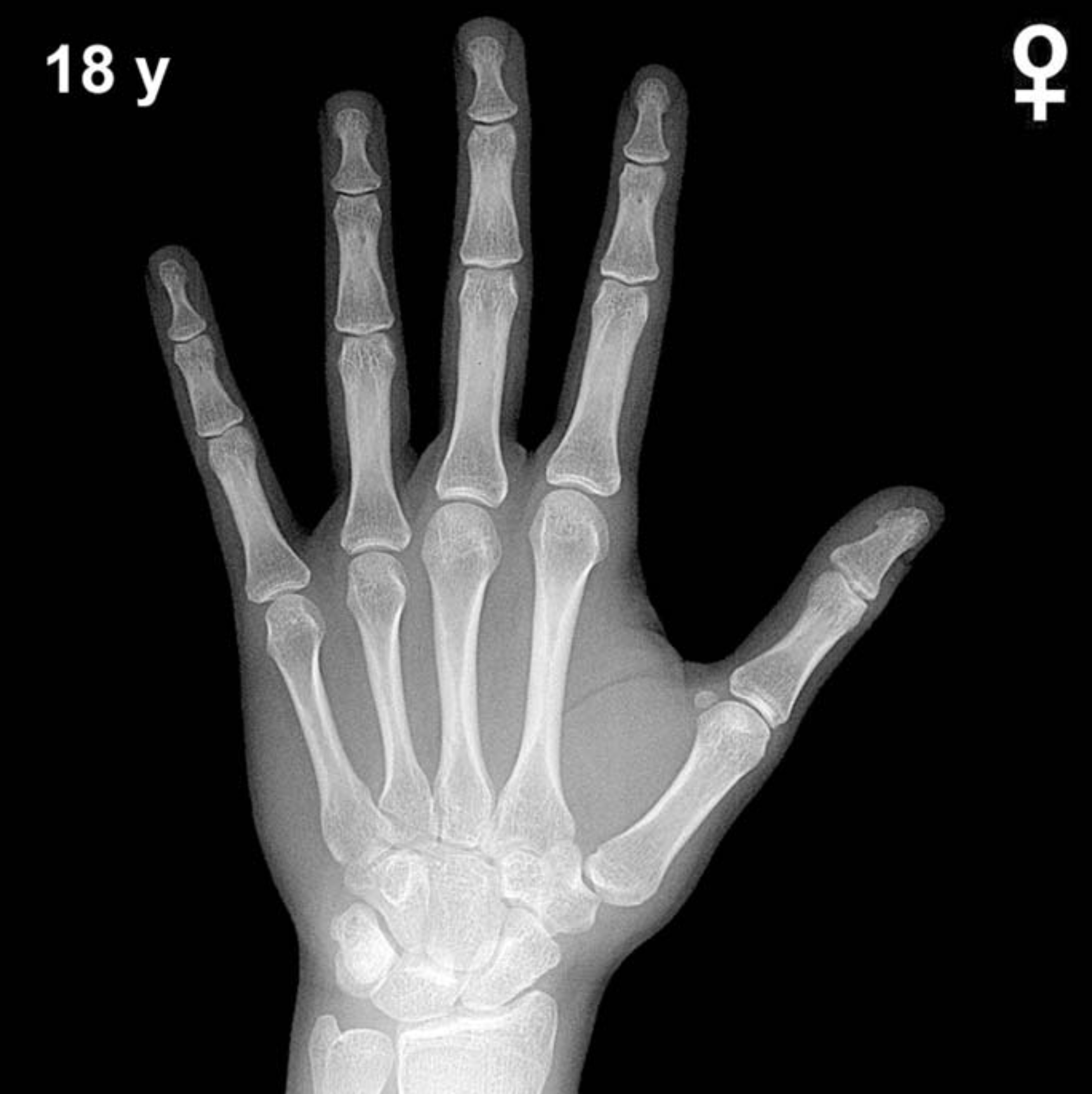 Bone age hand x-ray of a 18 year old girl