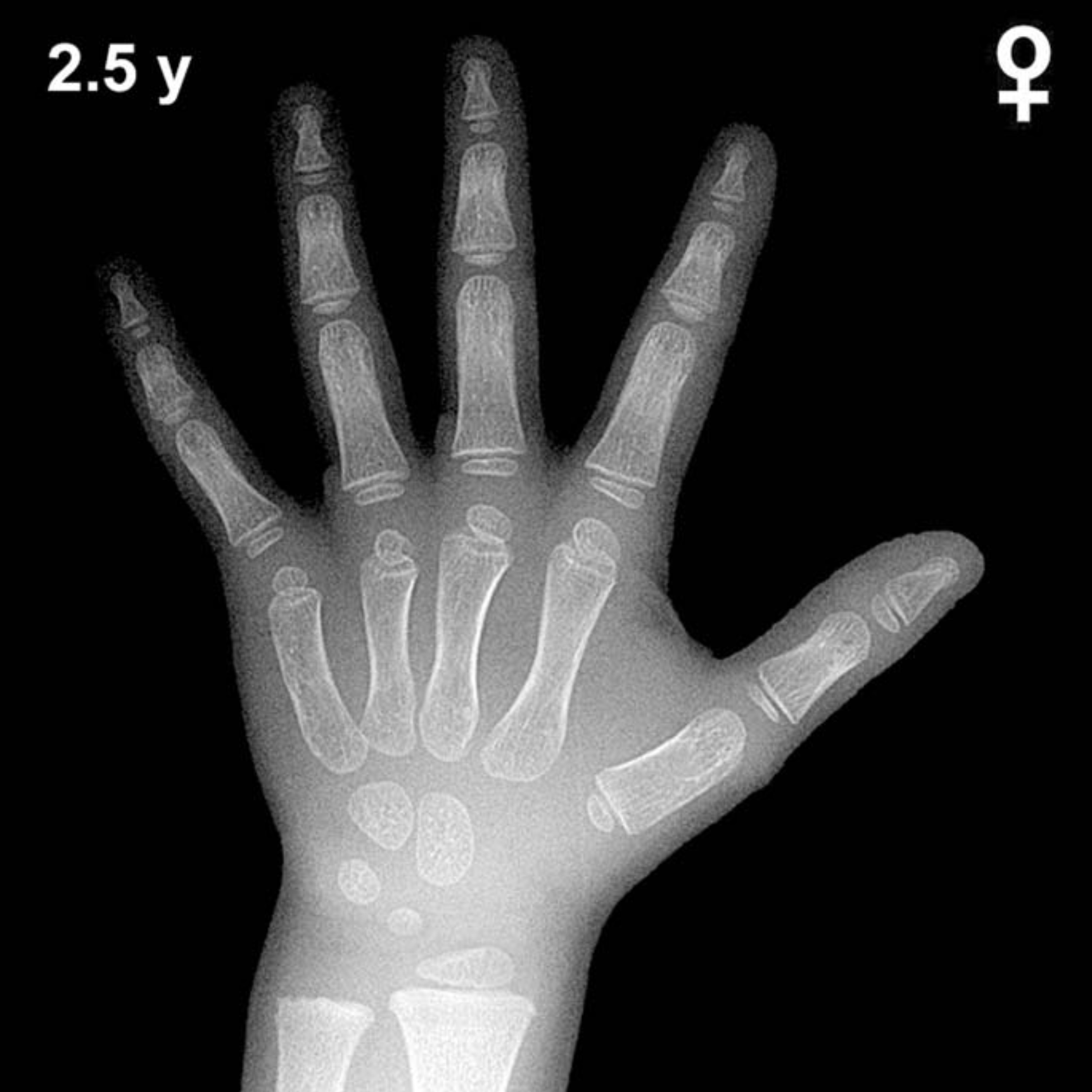 Bone age hand x-ray of a 2.5 year old girl