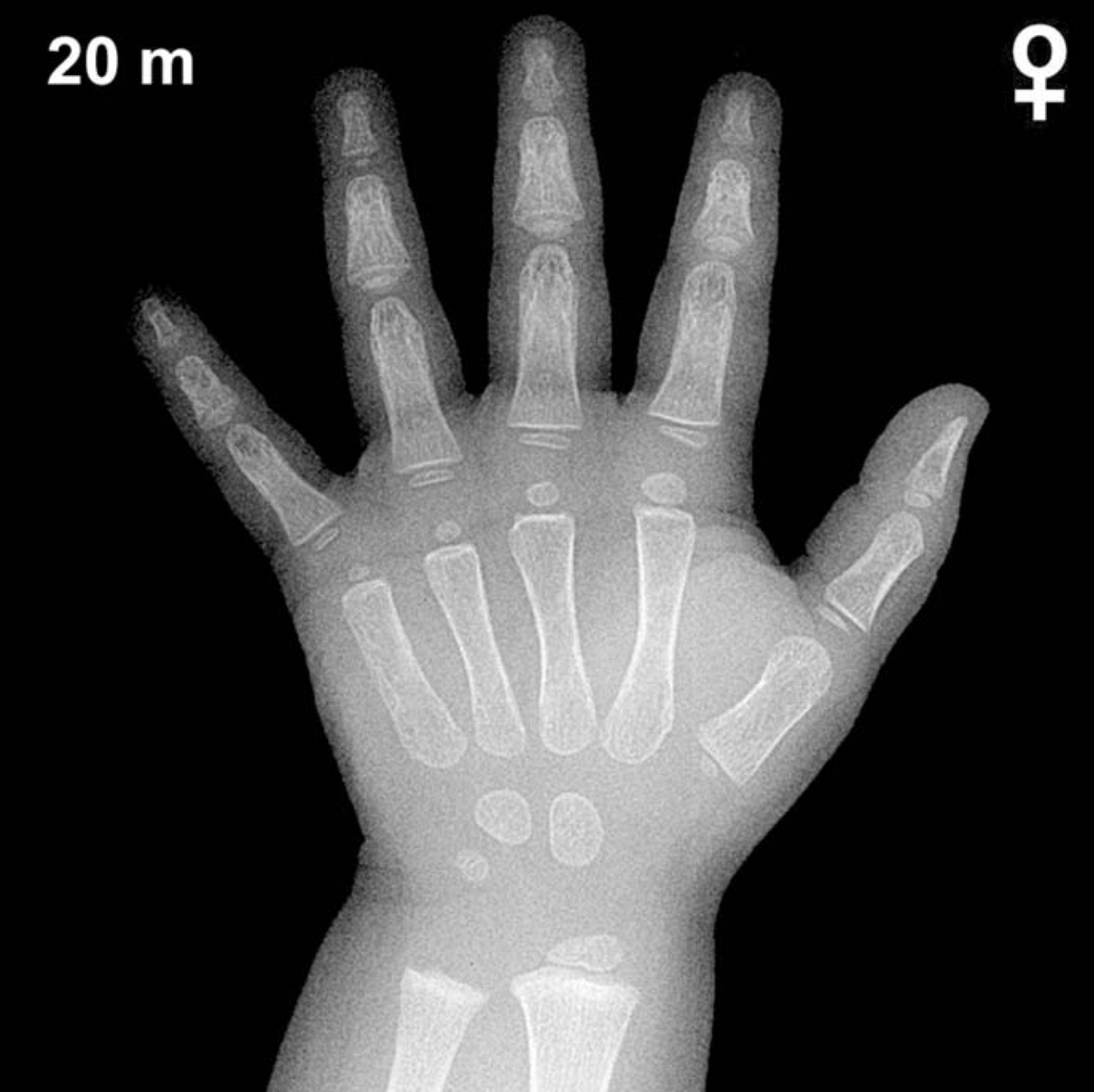 Bone age hand x-ray of a 20 month old girl
