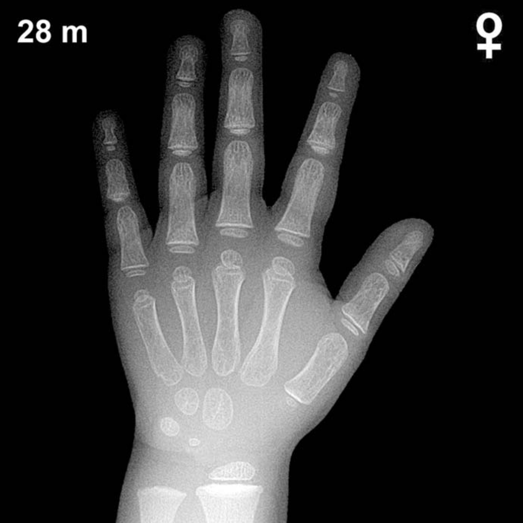 Bone age hand x-ray of a 28 month old girl