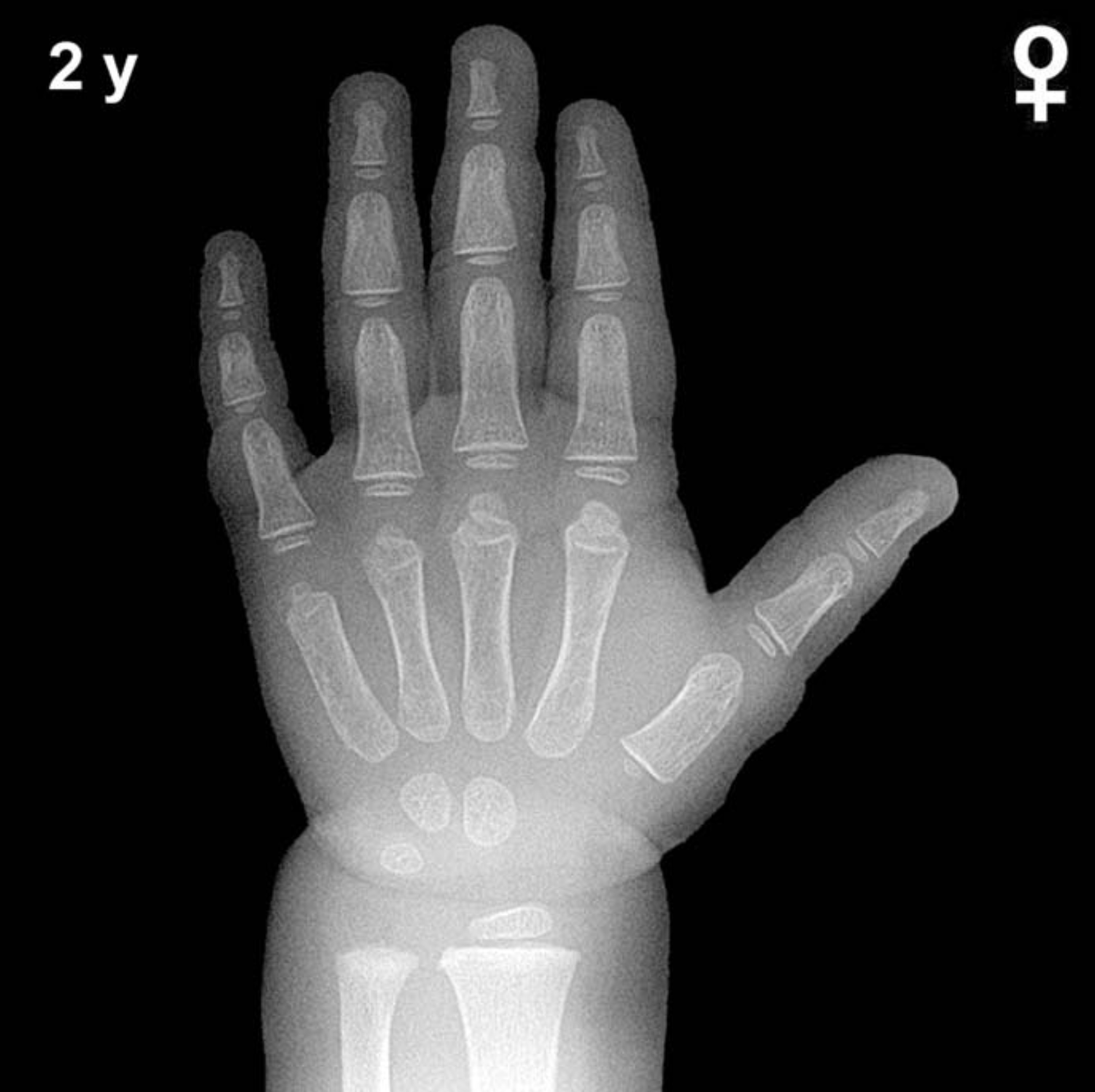 Bone age hand x-ray of a 2 year old girl