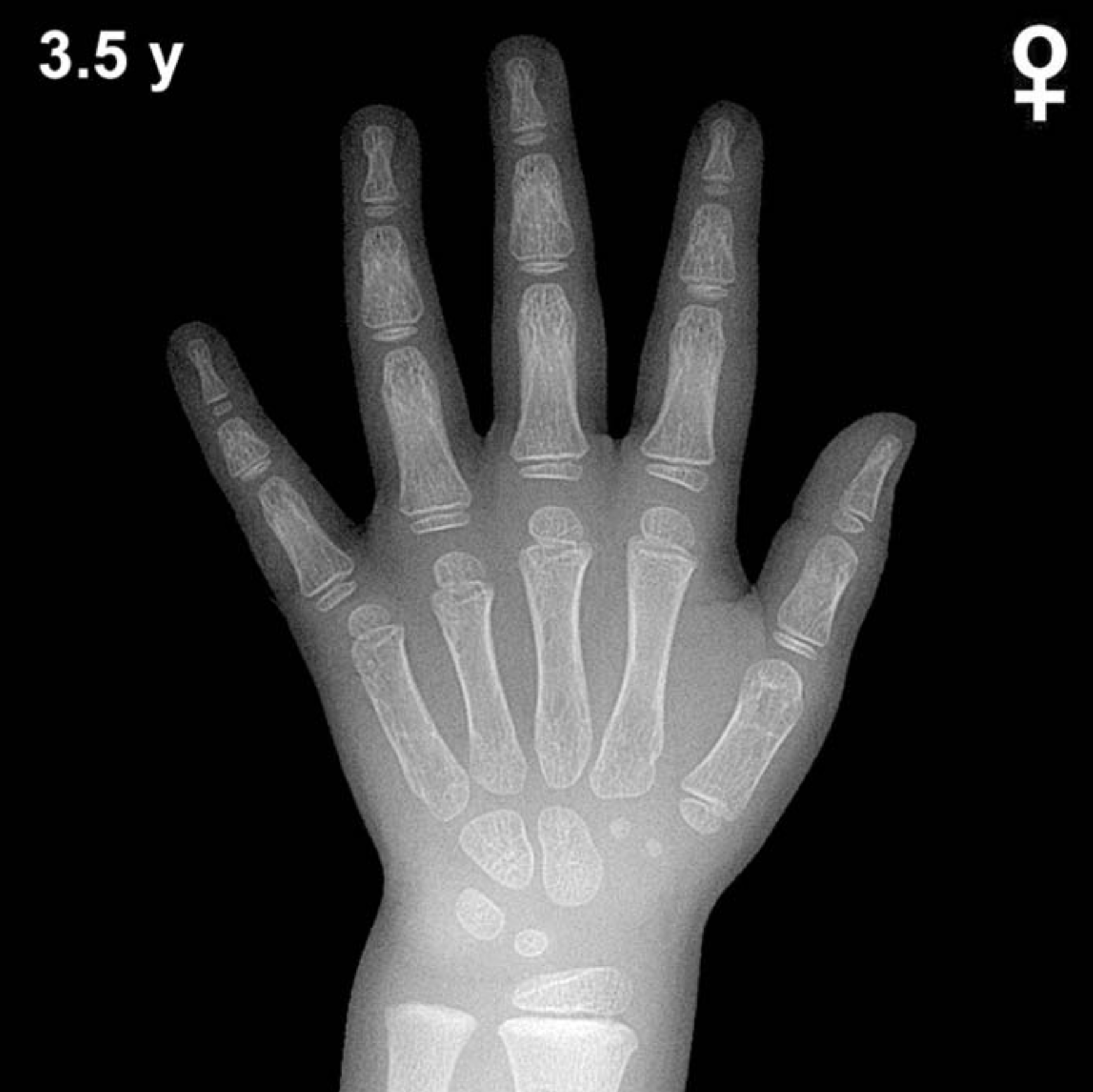 Bone age hand x-ray of a 3.5 year old girl