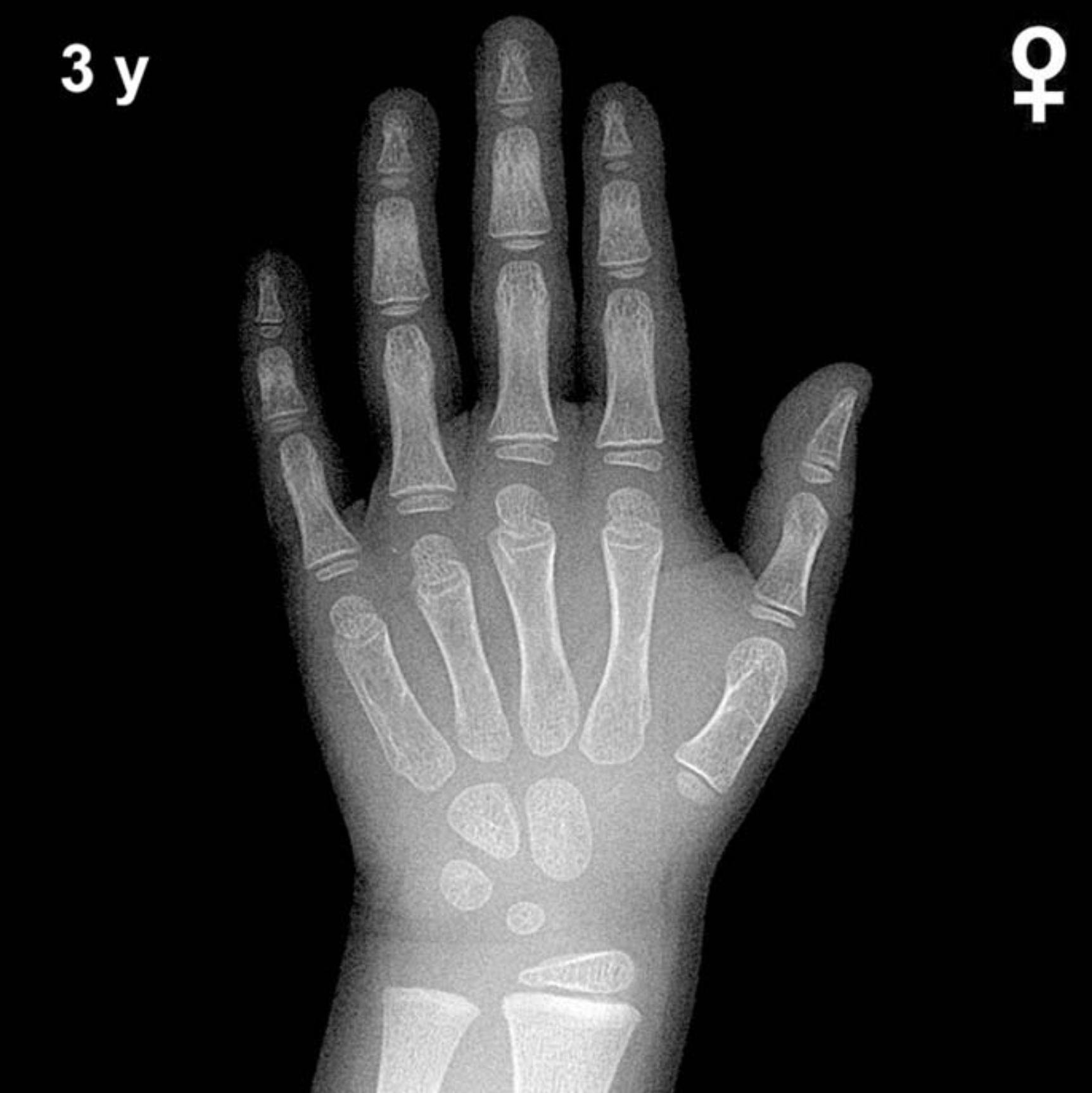 Bone age hand x-ray of a 3 year old girl
