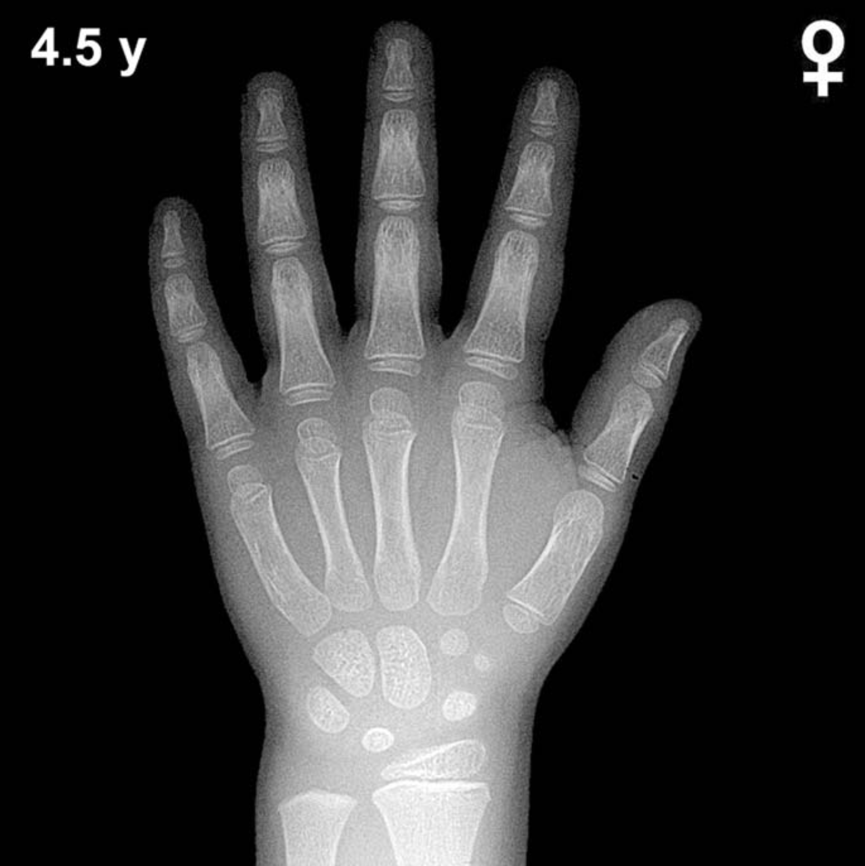 Bone age hand x-ray of a 4.5 year old girl
