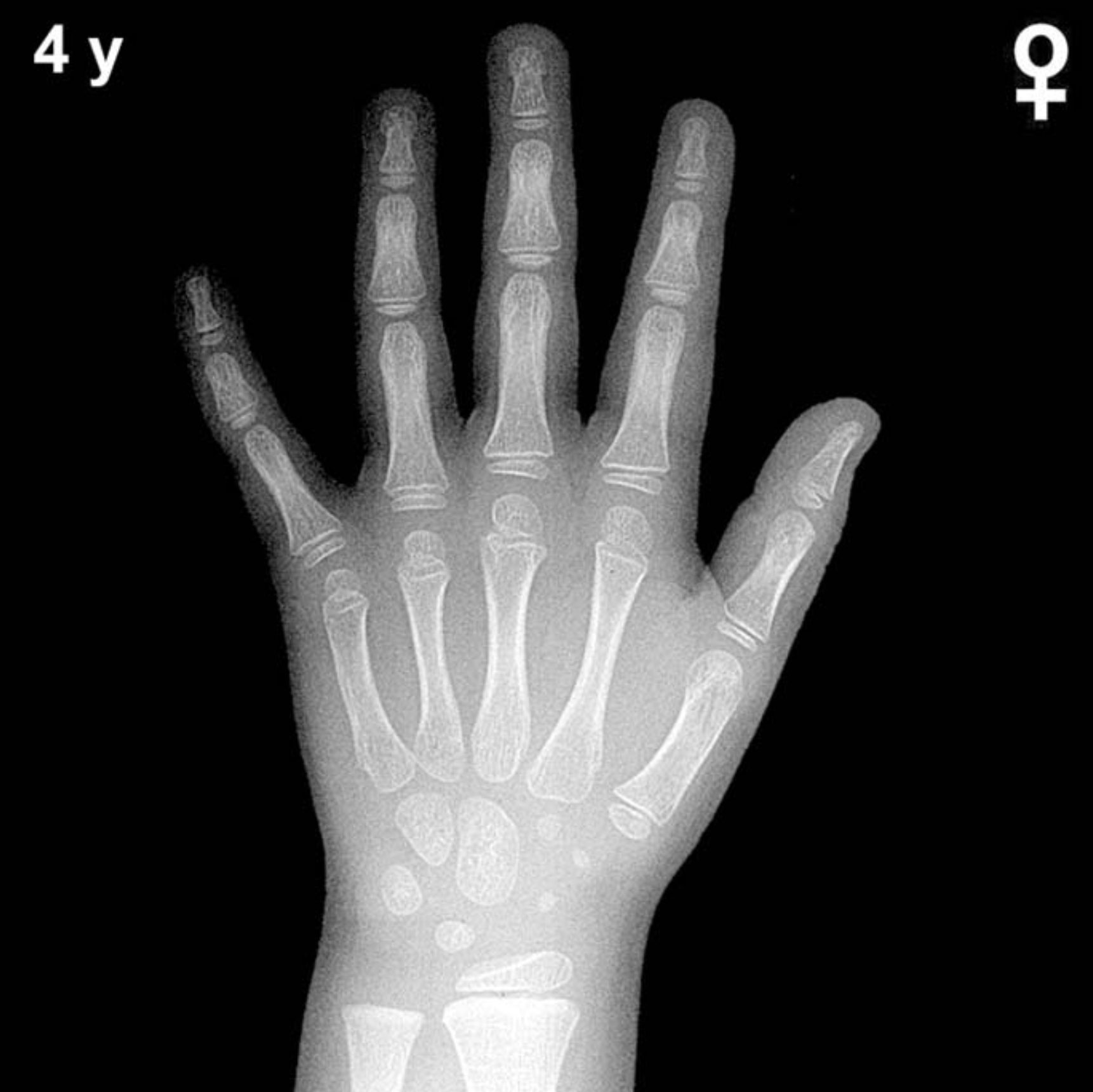 Bone age hand x-ray of a 4 year old girl