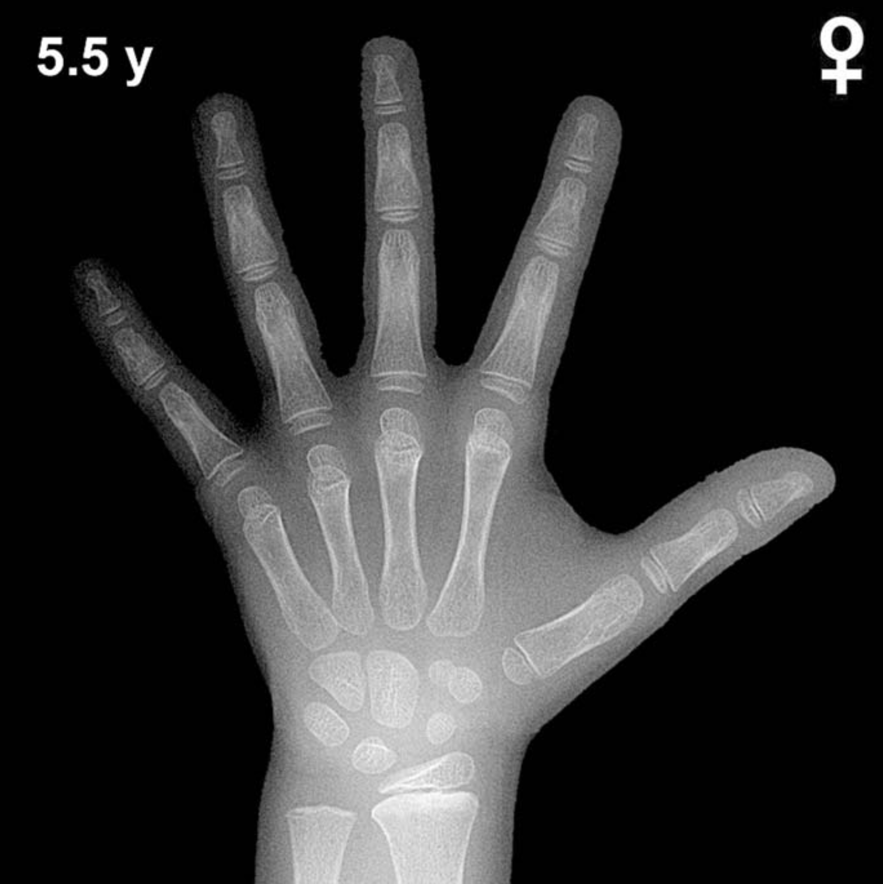 Bone age hand x-ray of a 5.5 year old girl