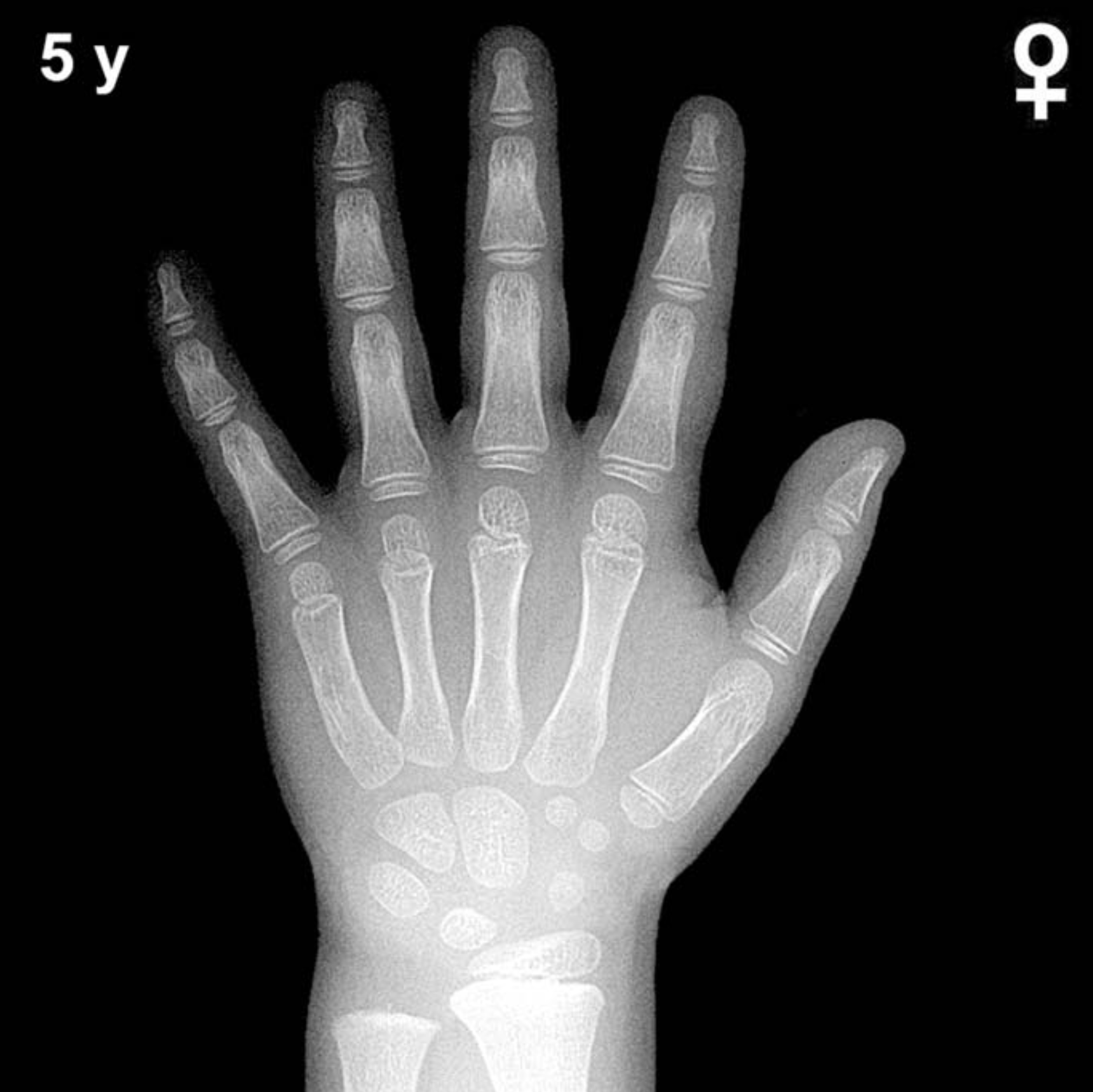 Bone age hand x-ray of a 5 year old girl