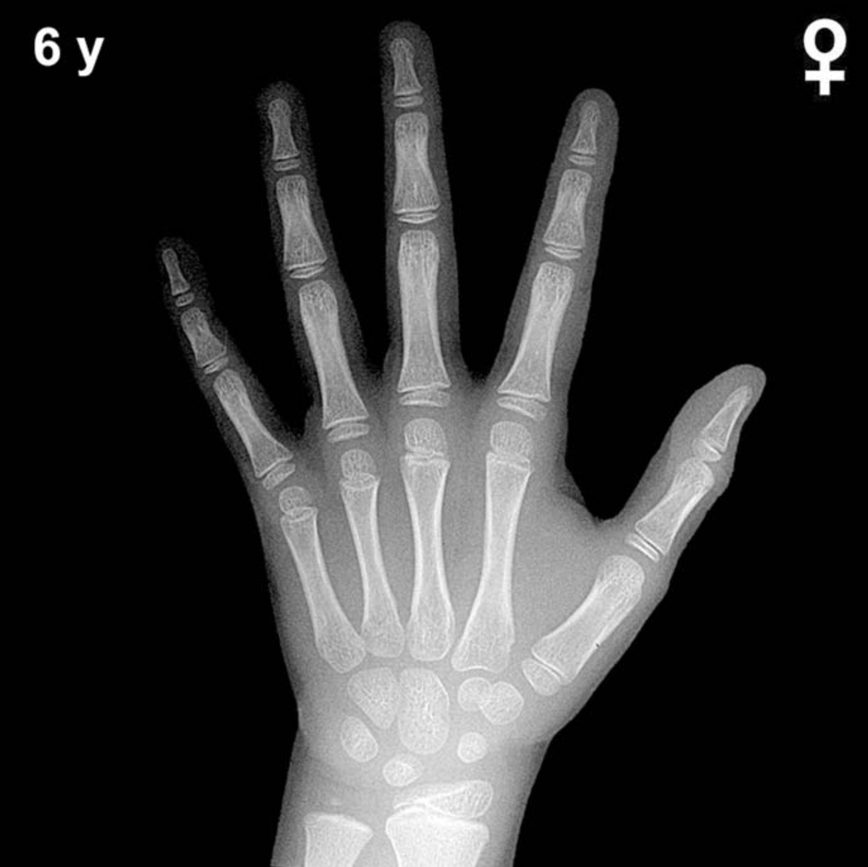 Bone age hand x-ray of a 6 year old girl