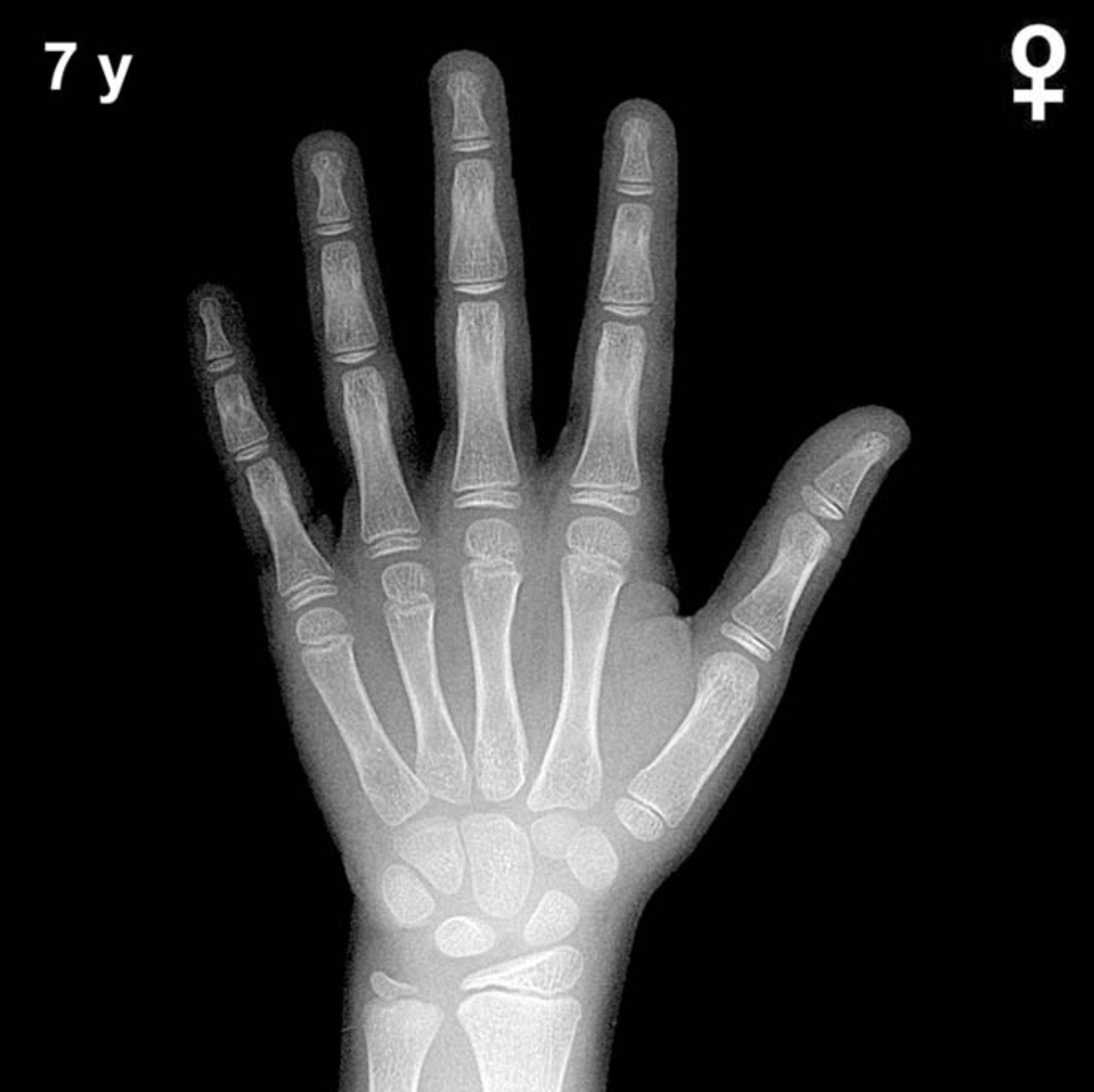 Bone age hand x-ray of a 7 year old girl