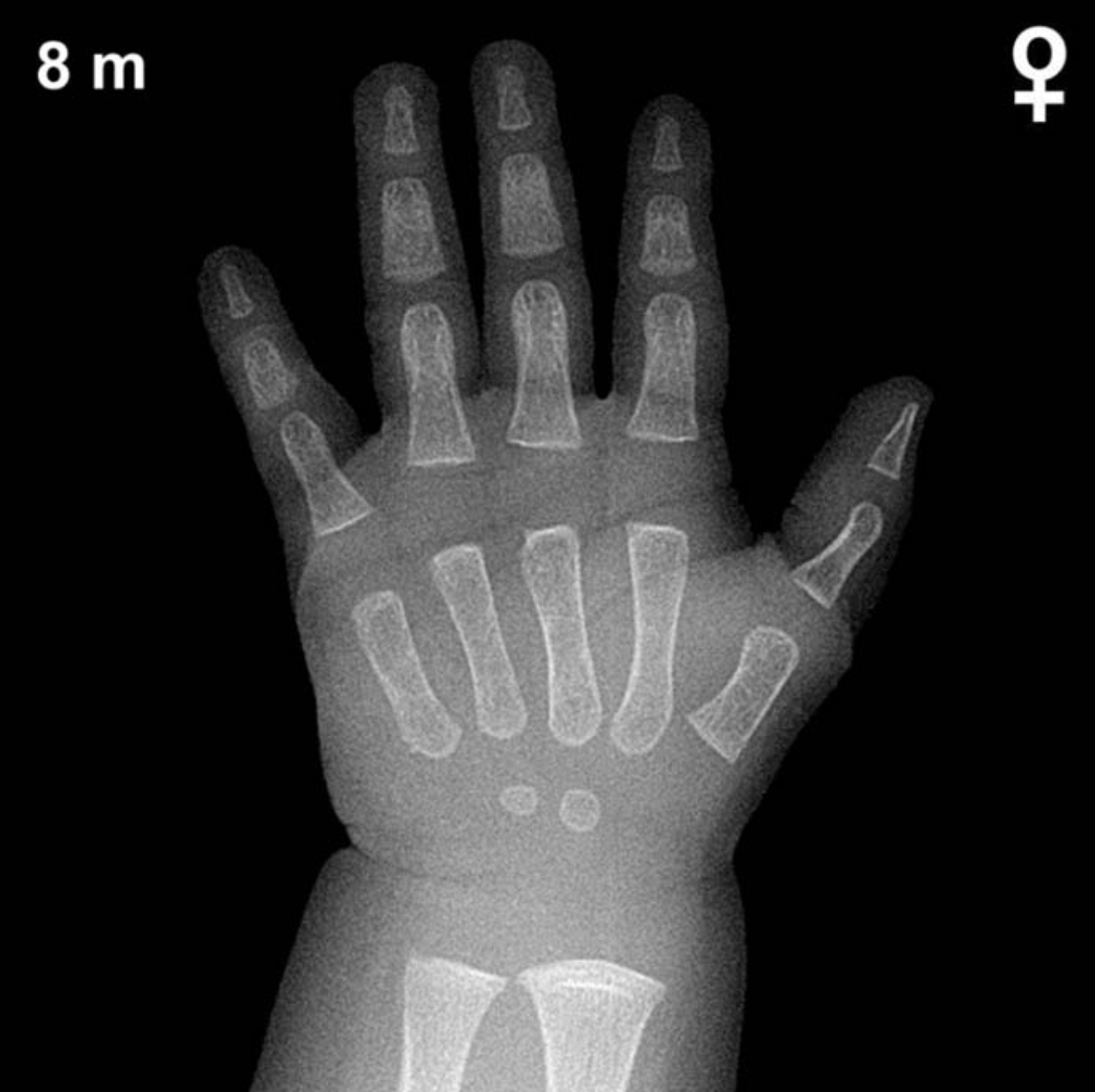 Bone age hand x-ray of a 8 month old girl