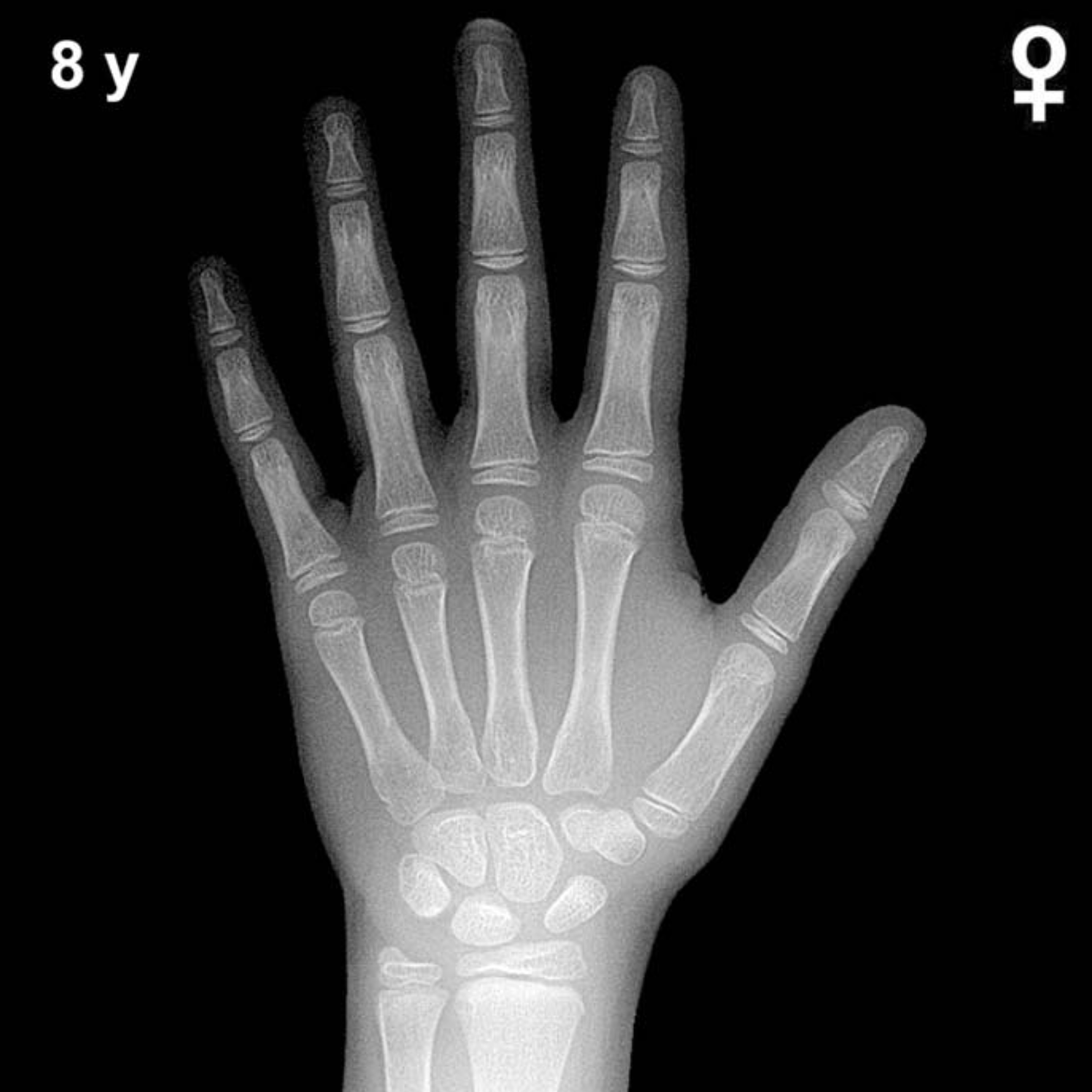 Bone age hand x-ray of a 8 year old girl