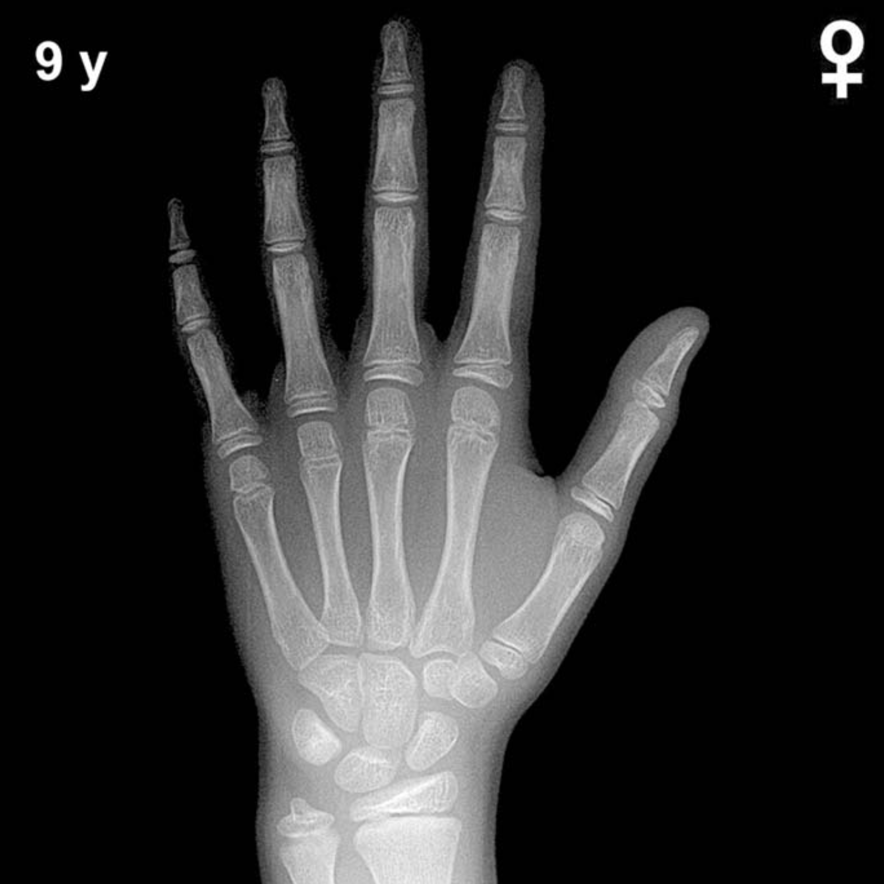 Bone age hand x-ray of a 9 year old girl